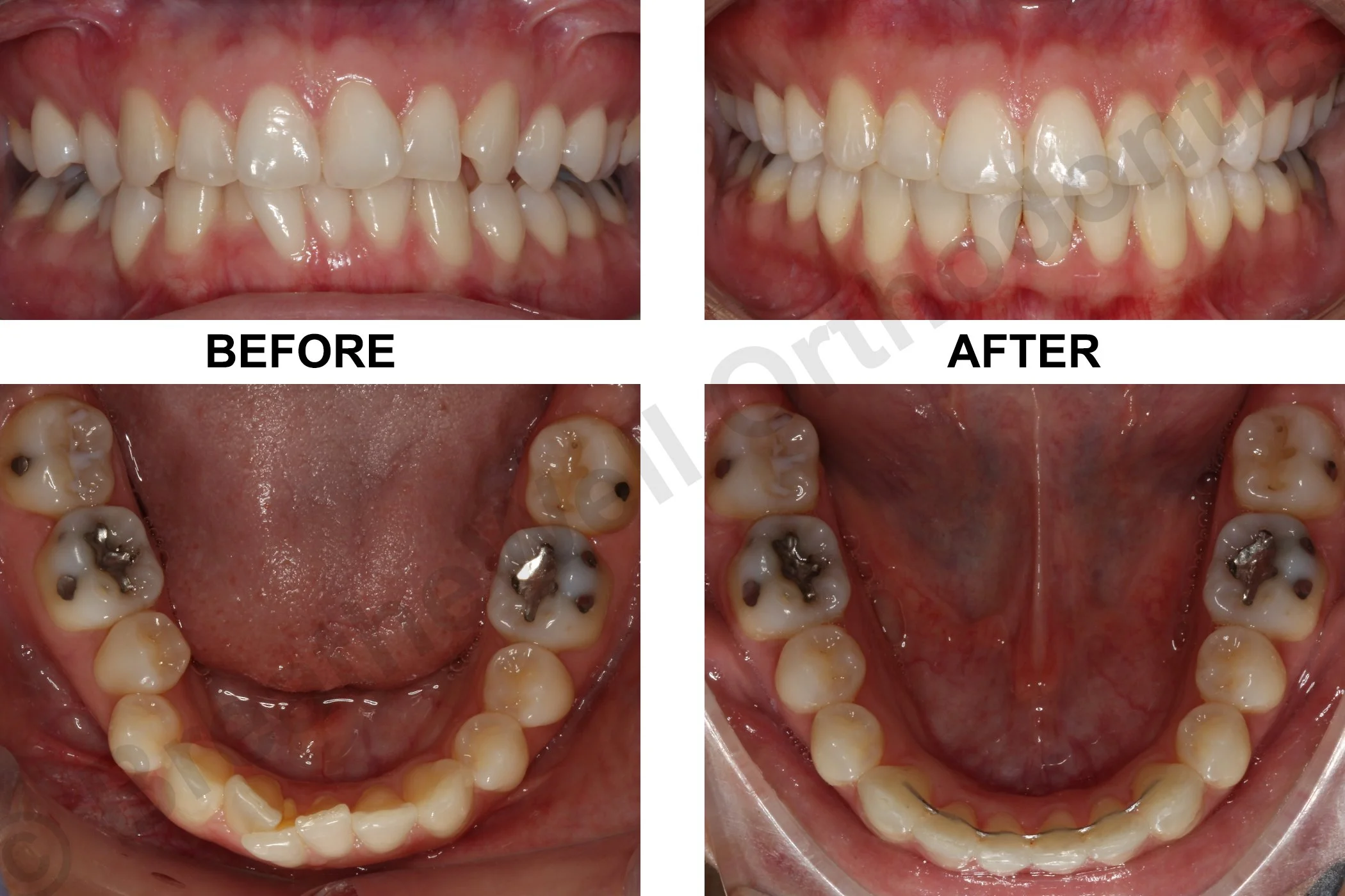 SEVERE CROWDING AND ASYMMETRY