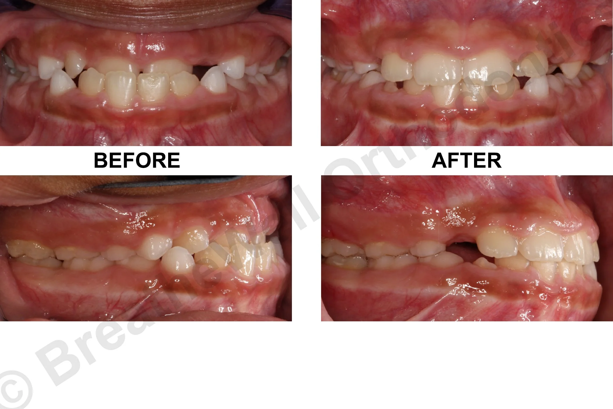 EARLY TREATMENT FOR UNDERBITE