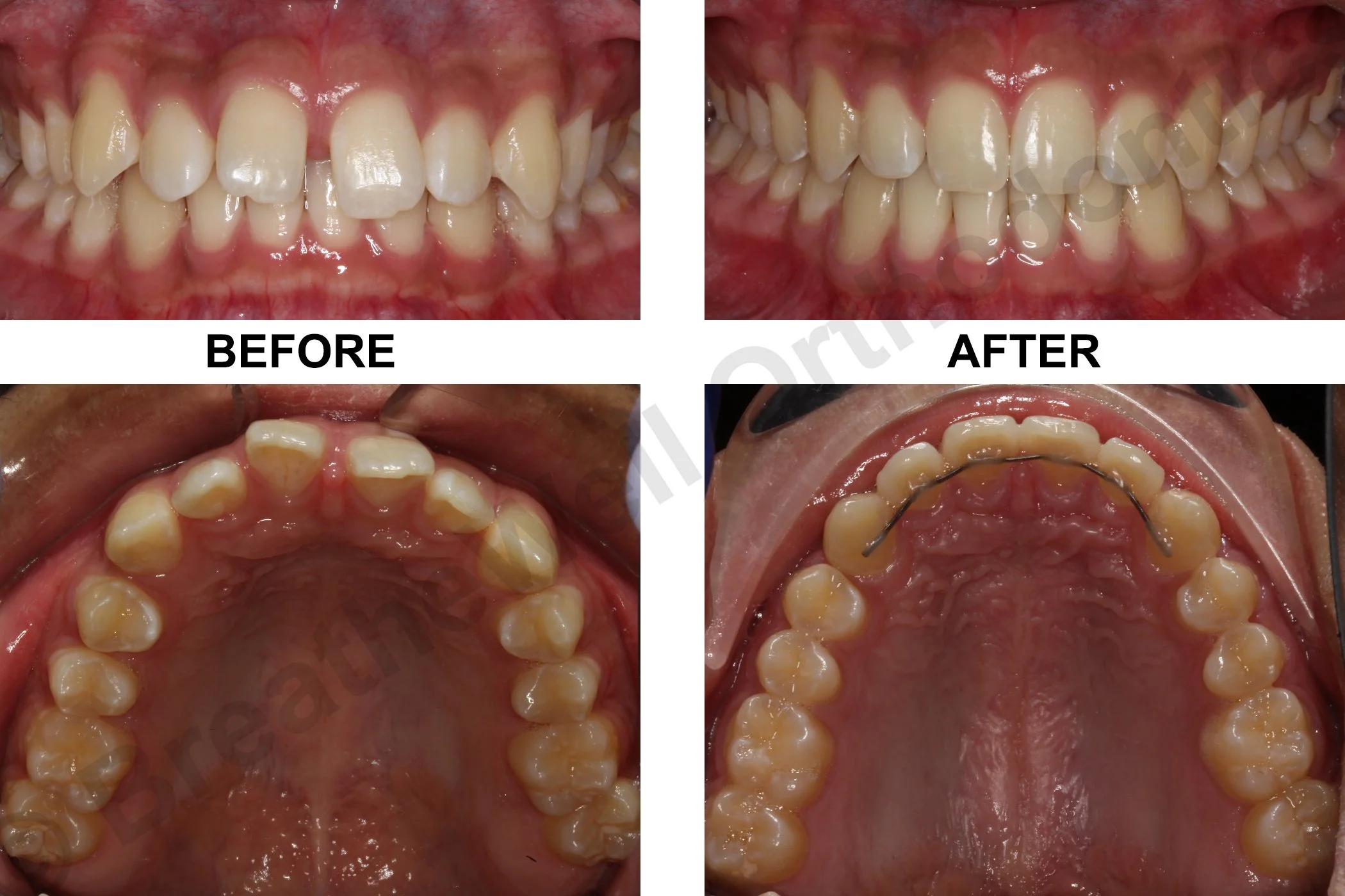 SPACING, OVERJET AND DEEP BITE
