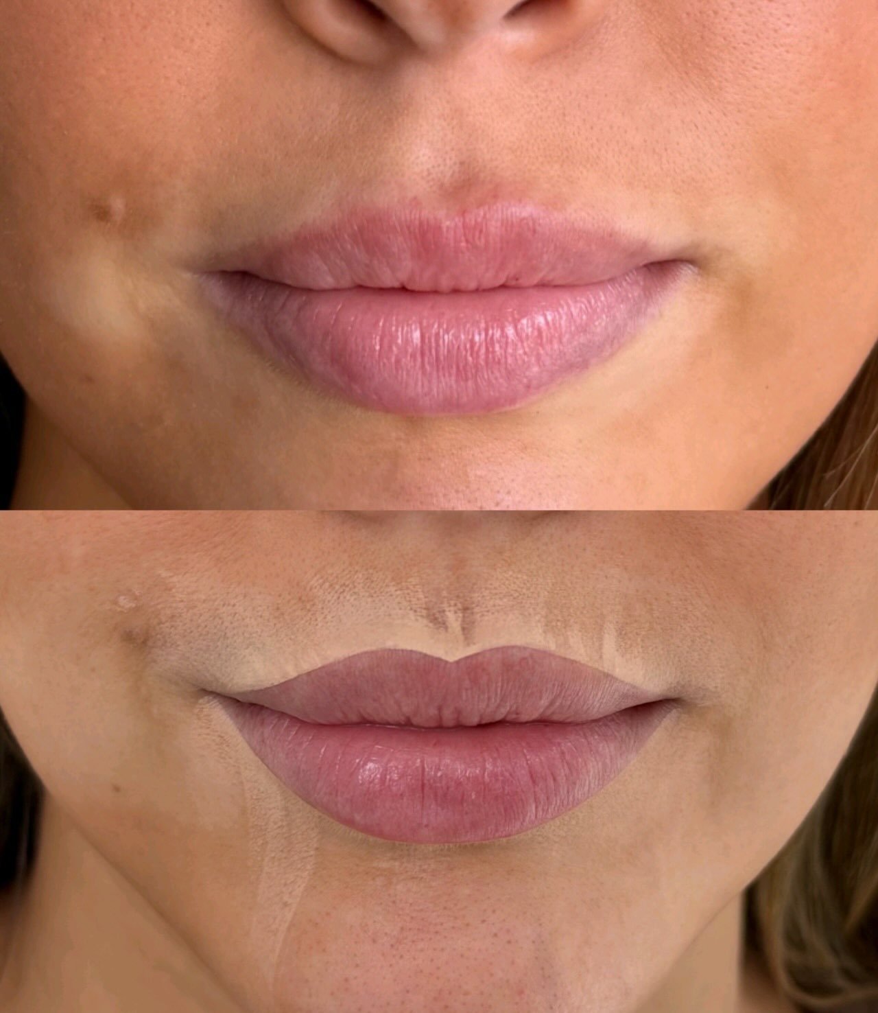 Here are some of my tips for mapping lips with filler 👄✨
1. Use the natural lip point as your guide. Look at the natural points of the lips and use the skin as your reference. Follow the lip skin rather than the pores.
2. Don&rsquo;t just look at th