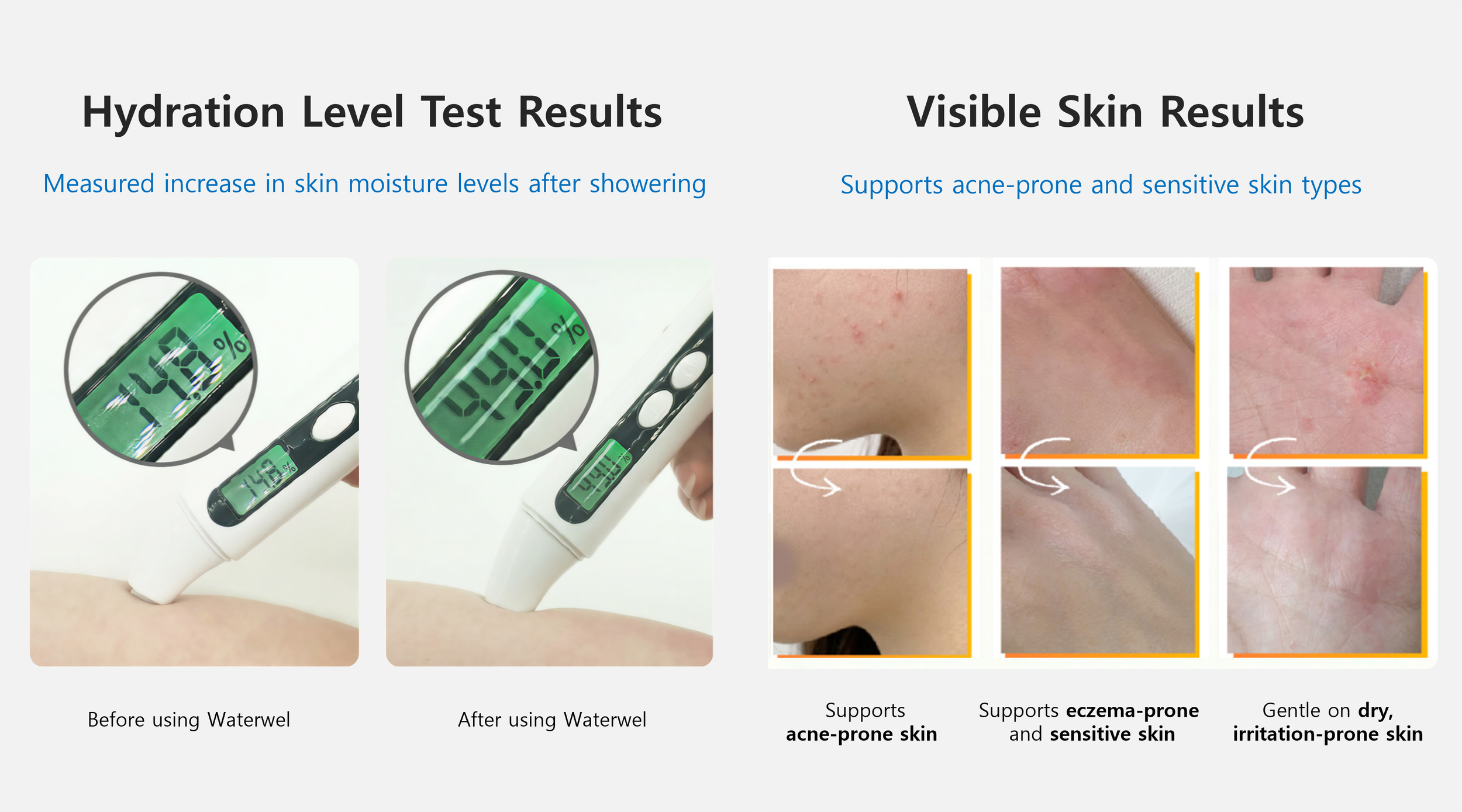 Poster comparing hydration levels and skin conditions, showing a water thermometer before and after use, and skin images of acne-prone, sensitive, and irritated skin.