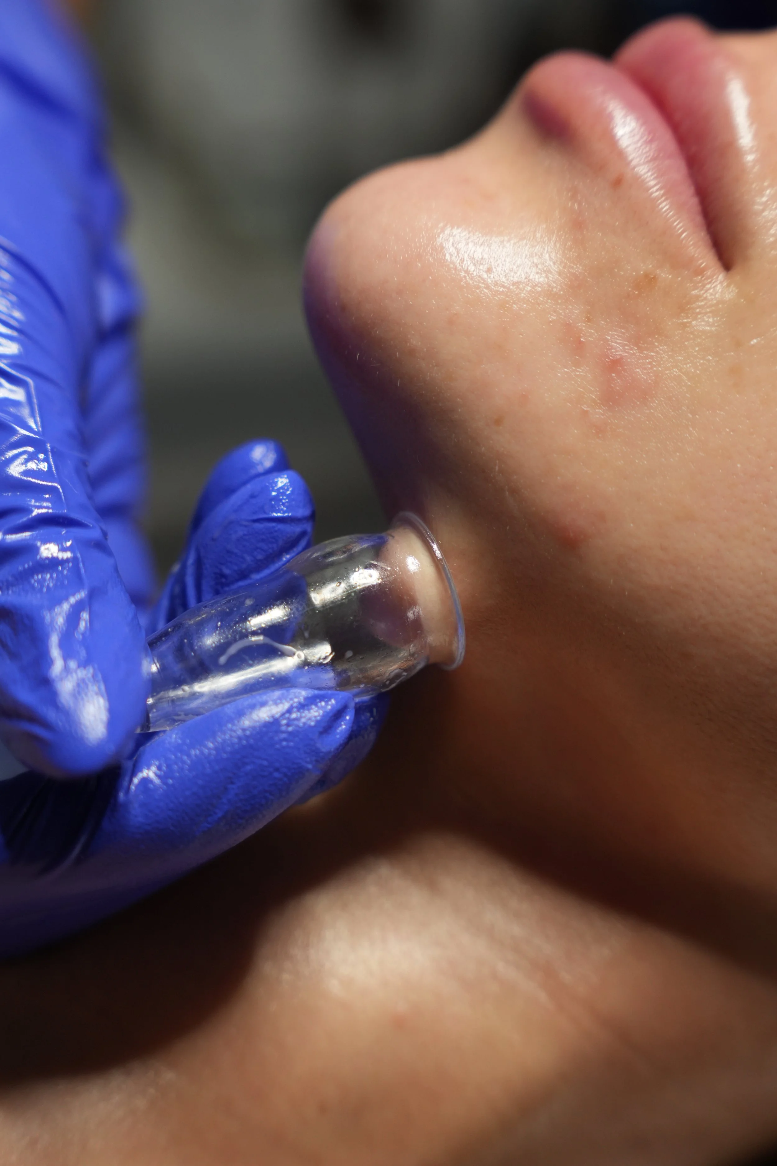 Close-up of a person receiving a cosmetic injection in the chin area, with a gloved hand holding a syringe.