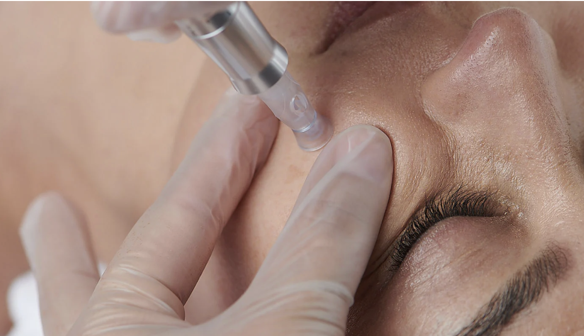 Microneedling with Peptides