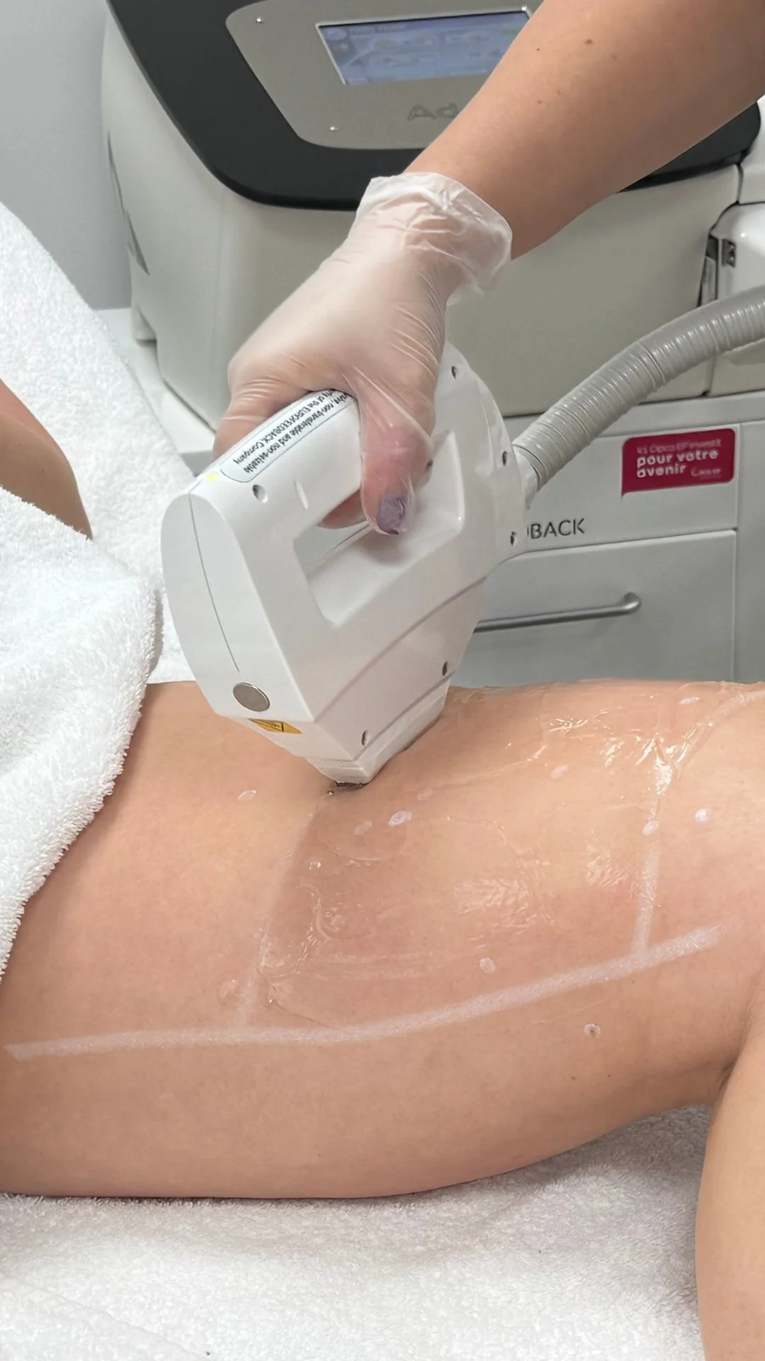 Une personne subit un traitement dermatologique à l'aide d'un appareil médical sur une zone de son corps, probablement une séance de peeling ou de laser.