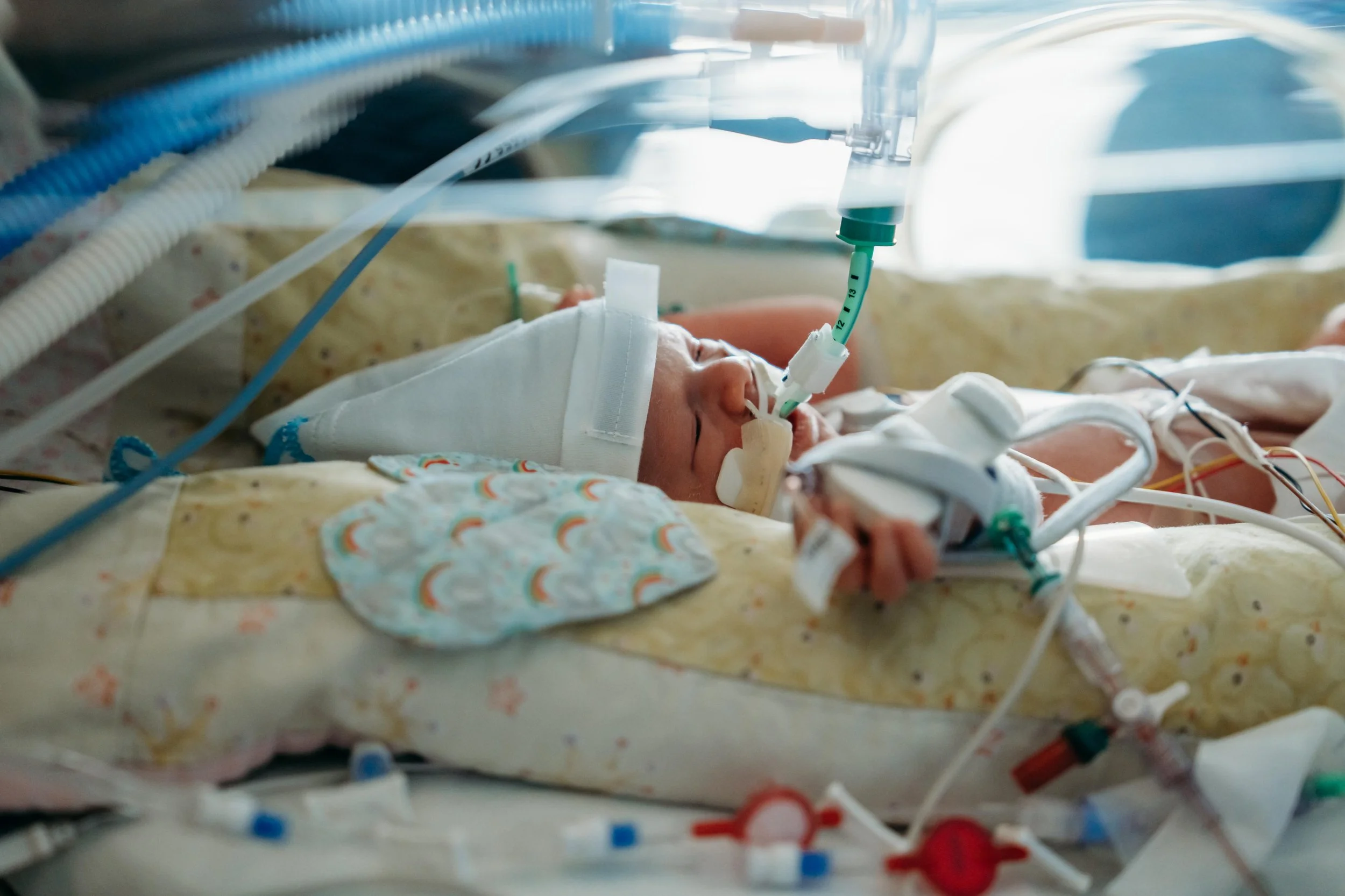 Premature baby lying in a neonatal incubator surrounded by medical tubes and monitoring equipment in a hospital setting