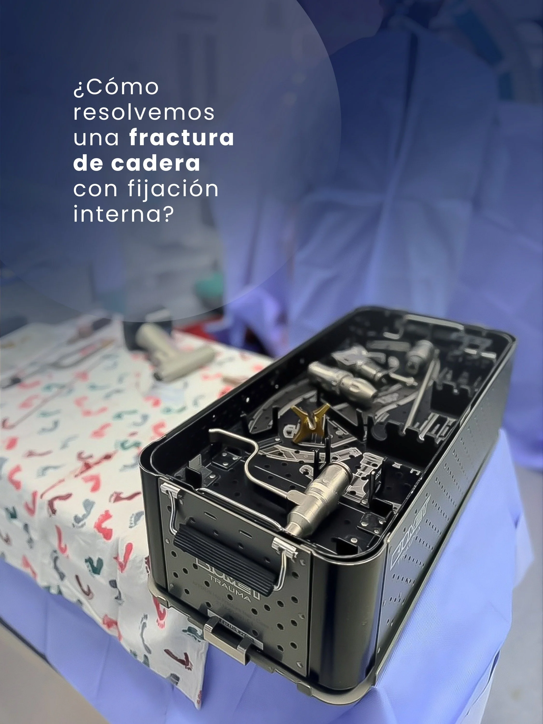Hoy quiero contarte sobre uno de los procedimientos m&aacute;s eficientes en traumatolog&iacute;a:

La osteos&iacute;ntesis (con clavo) para fracturas de cadera. 🦴🏃🏼&zwj;♂️

Este sistema no solo sostiene el hueso, sino que distribuye las fuerzas m