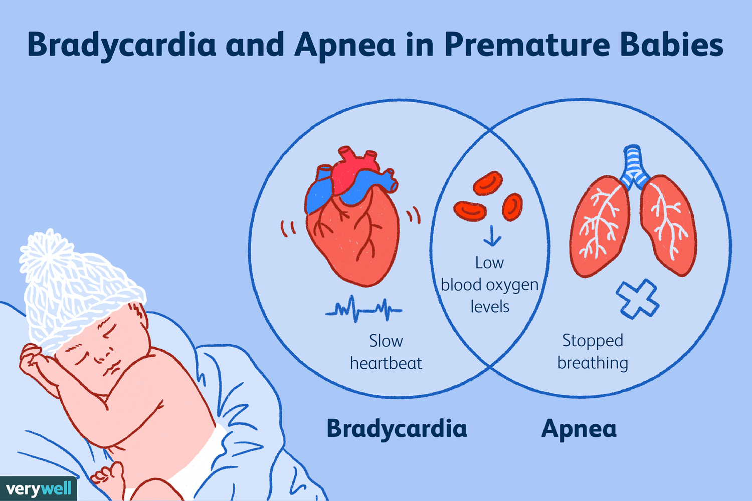 What’s the Difference Between a Brady, a Desat, and Apnea in the NICU?