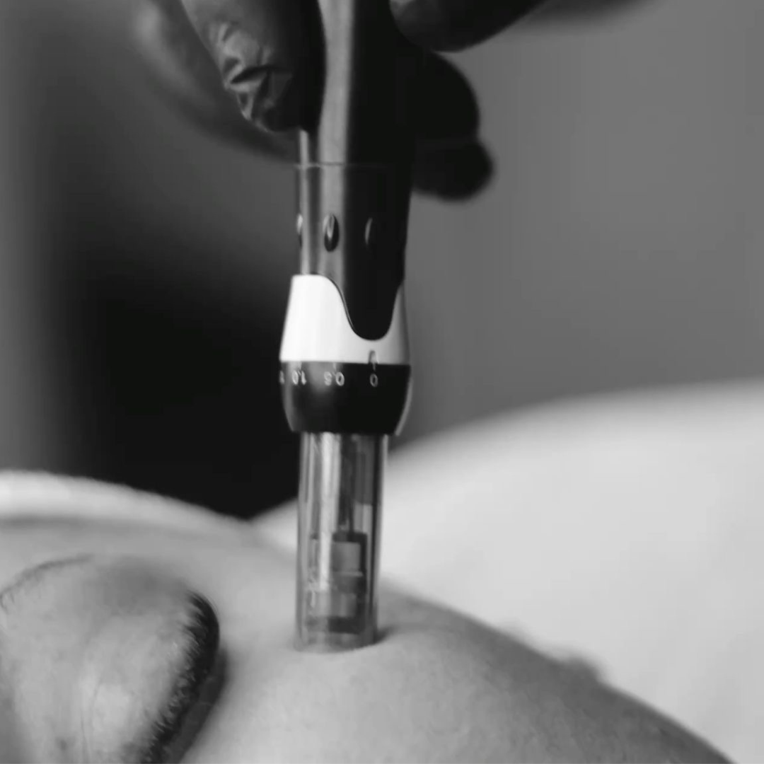 Medspa in Imperial, MO, 63052 | Microneedling Near Me