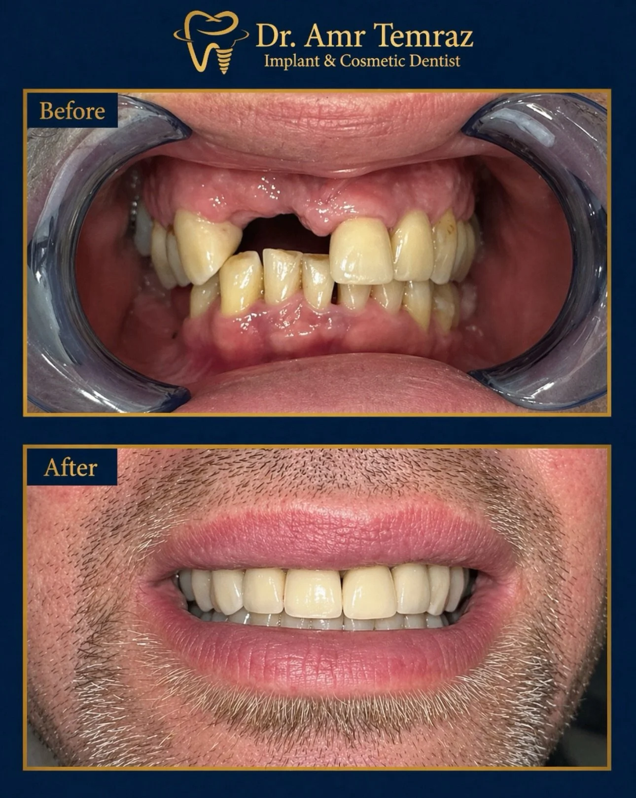 Dental implant transformation ✨

Replacing two missing front teeth with dental implants to restore a natural-looking smile, function, and confidence.

📍Manchester &amp; Blackburn
📩 DM for consultations &amp; enquiries

#DentalImplantsUK #FrontTeeth