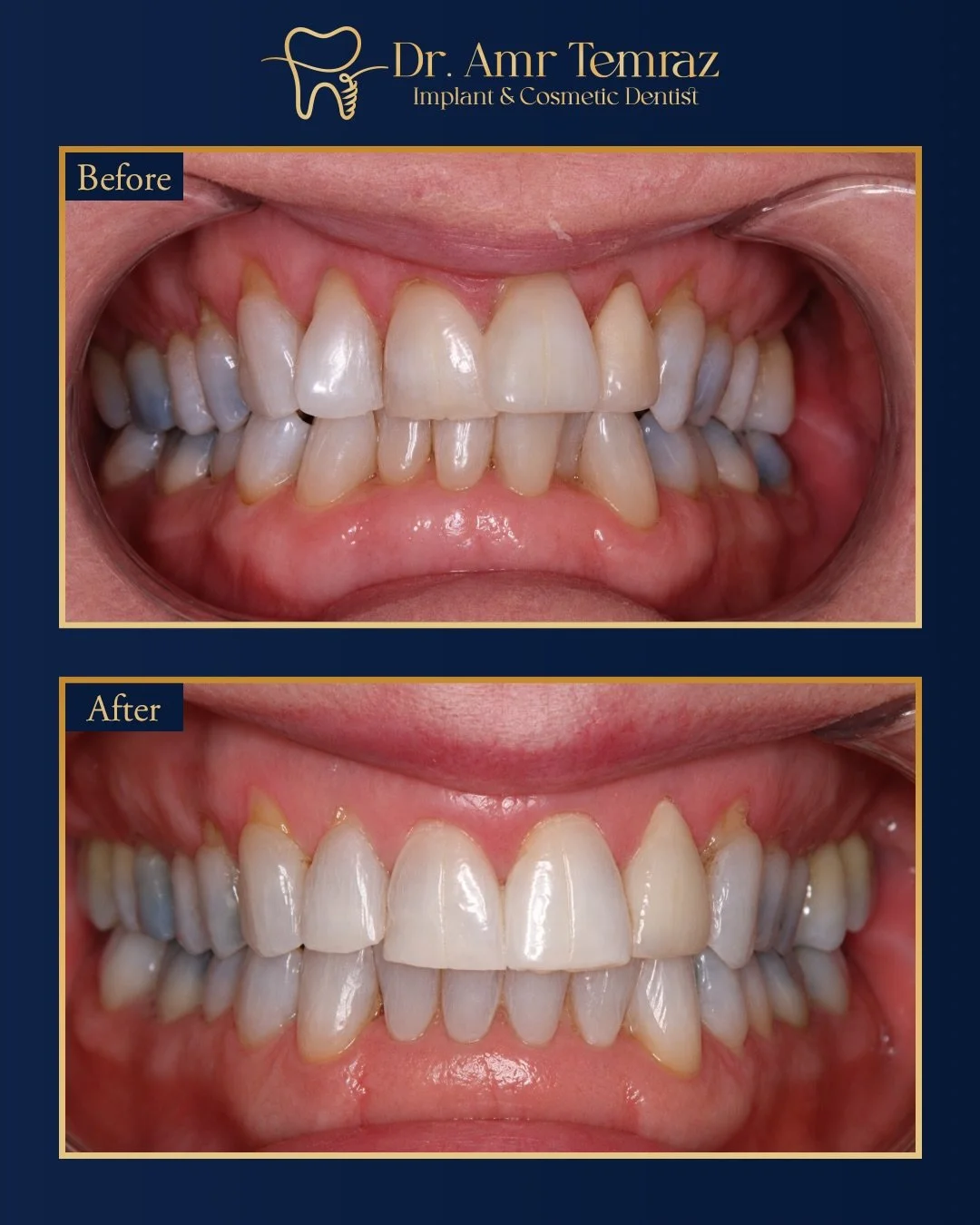 Clear aligner transformation ✨

A personalised clear aligner treatment to create a straighter, healthier smile while keeping the result natural and balanced.

Swipe to see the before &amp; after 👀

🌐 Thinking about improving your smile? Complete yo