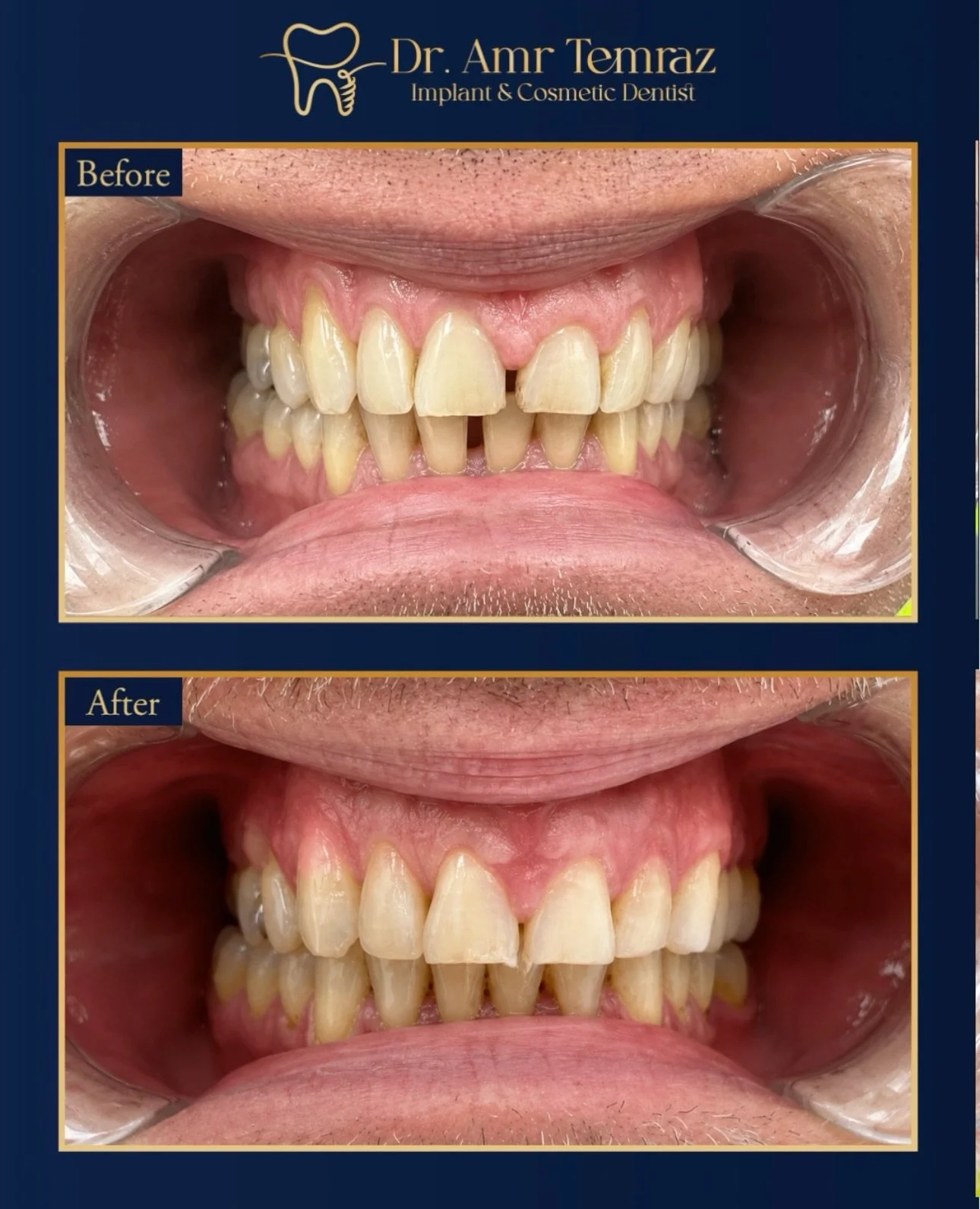 Swipe for the smile transformation ➡️✨

Clear aligners used to improve the alignment and bring everything into better balance &mdash; while keeping the final smile looking natural.

Thinking about straightening your teeth?

🌐 Complete your FREE onli