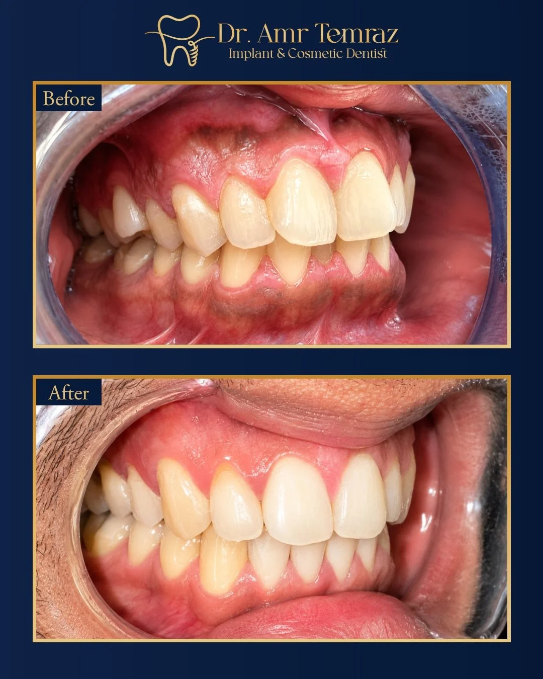 Swipe to see the transformation ➡️✨

Clear aligners used to create a straighter, more balanced smile with a natural-looking result.

Thinking about straightening your teeth?

🌐 Complete your FREE online smile assessment &mdash; link in bio.

📍Manch