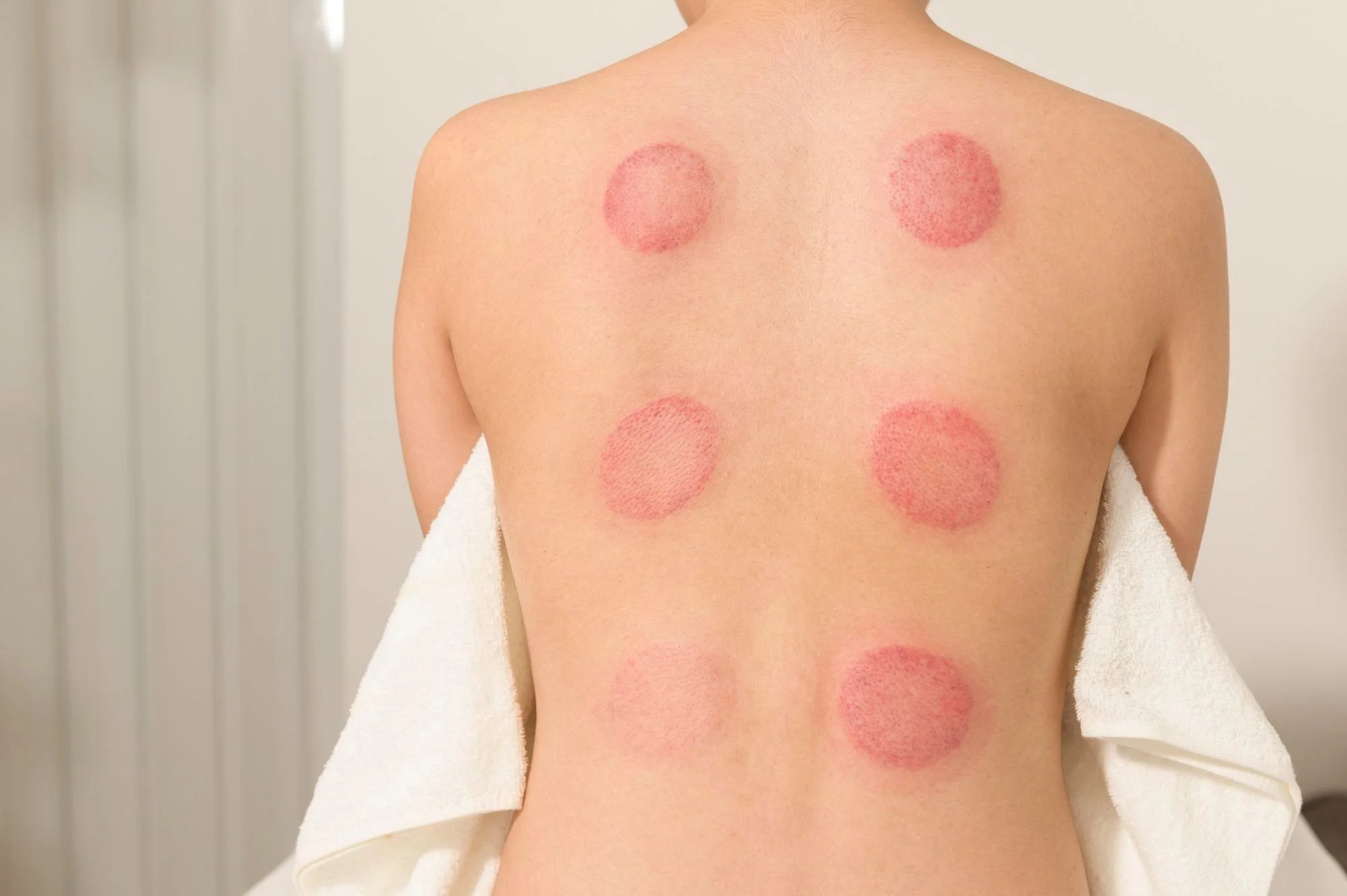 The Truth About Cupping Marks: Are They Bruises?