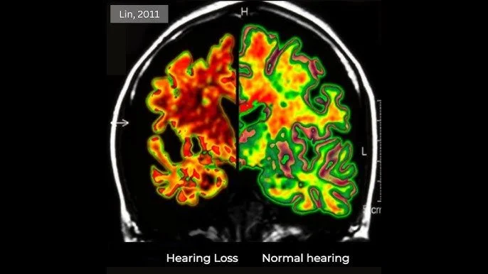 The Silent Link: How Untreated Hearing Loss Raises Dementia Risk — And What You Can Do About It
