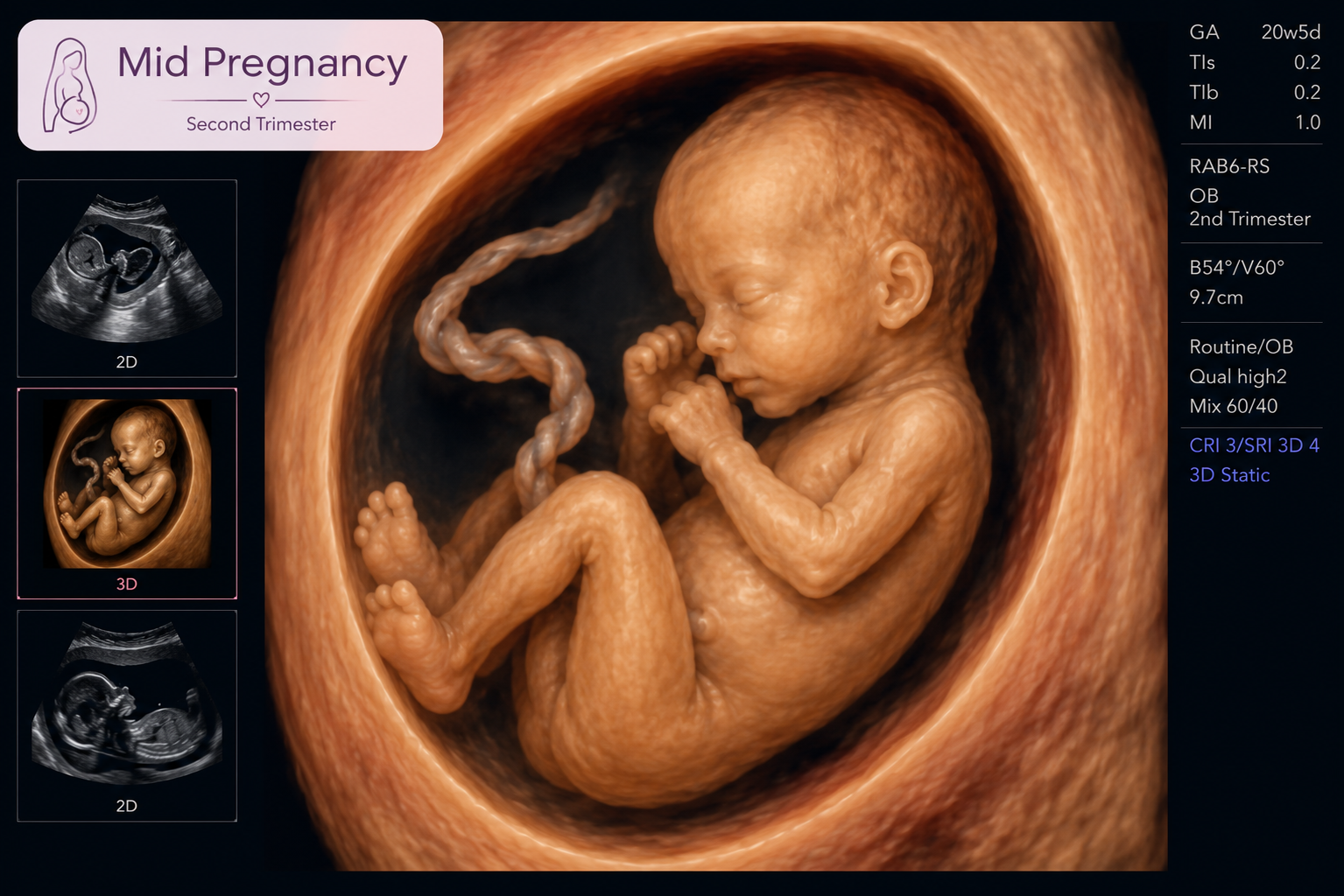 3D ultrasound image of a fetus in the second trimester, with detailed anatomy showing the head, limbs, and umbilical cord.