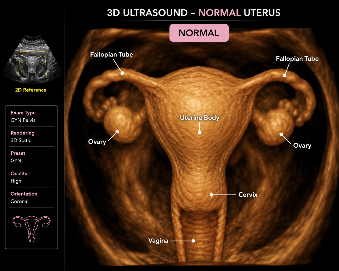 3D ultrasound image of a normal female reproductive system showing the uterus, fallopian tubes, ovaries, cervix, and vagina, with labels indicating each part.