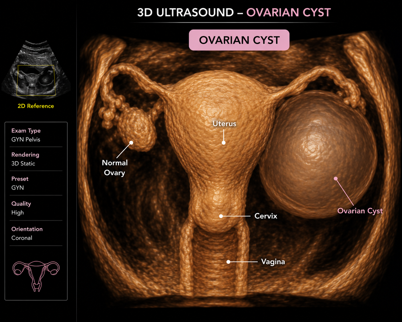3D ultrasound image of a female reproductive system showing an ovarian cyst on the right ovary, with labels for uterus, cervix, vagina, normal ovary on the left, and ovarian cyst on the right ovary.