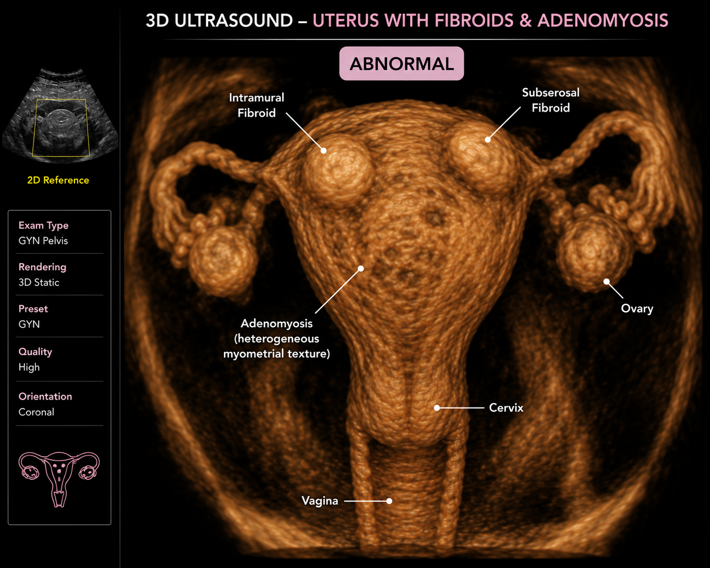 3D ultrasound image of a uterus with fibroids and adenomyosis, labeled to show intramural fibroid, subserosal fibroid, adenomyosis, ovary, cervix, and vagina, with an accompanying 2D reference image and descriptive information about the ultrasound and its quality.