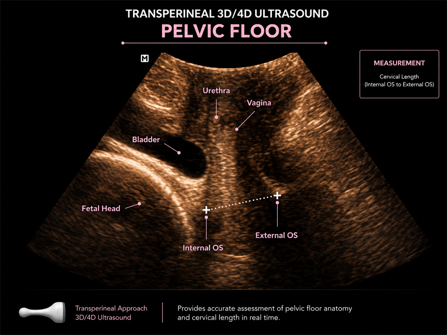 Ultrasound image of the pelvic floor showing the bladder, urethra, vagina, fetal head, and measurement from internal to external opening of the cervix.