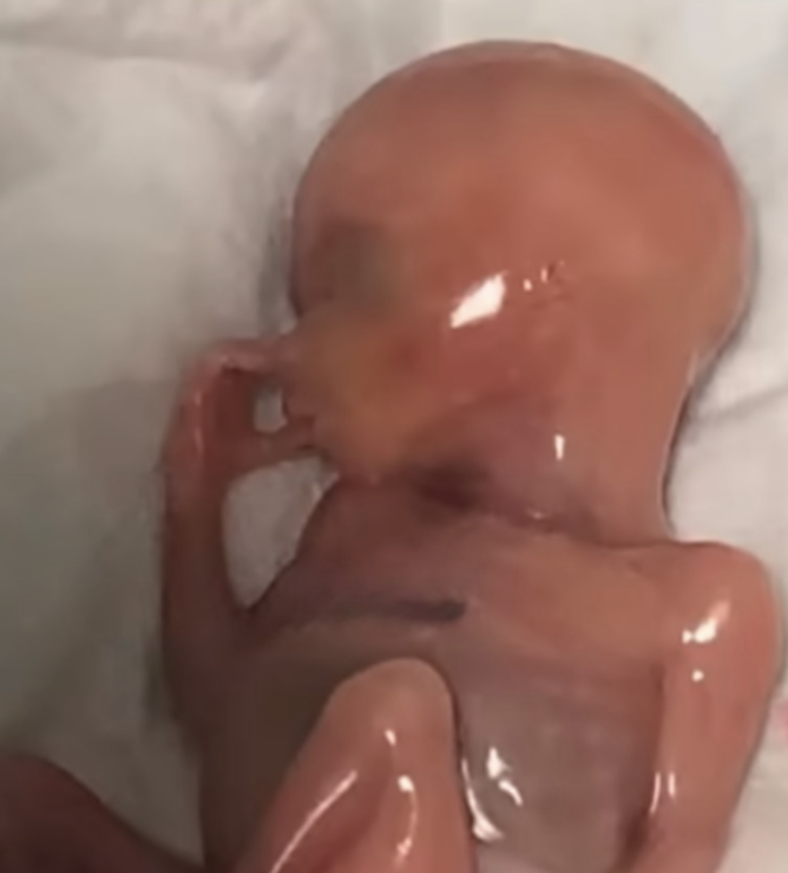 Speak Up For Baby Samuel