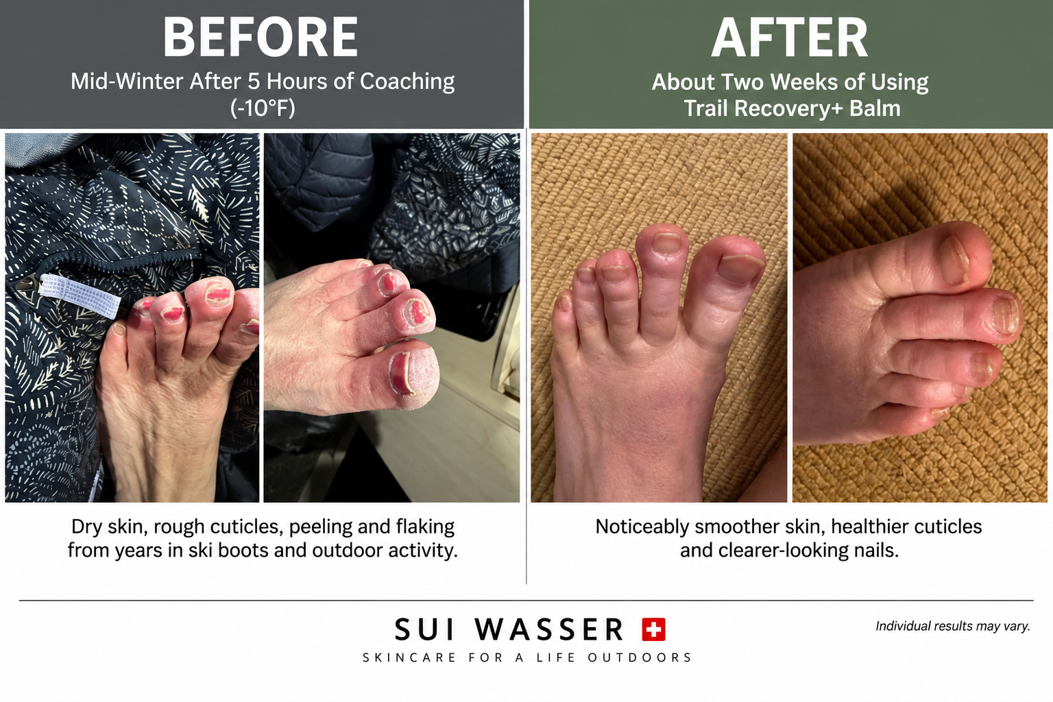 Case Study: Caring for Dry, Weather-Stressed Feet After Years in Ski Boots