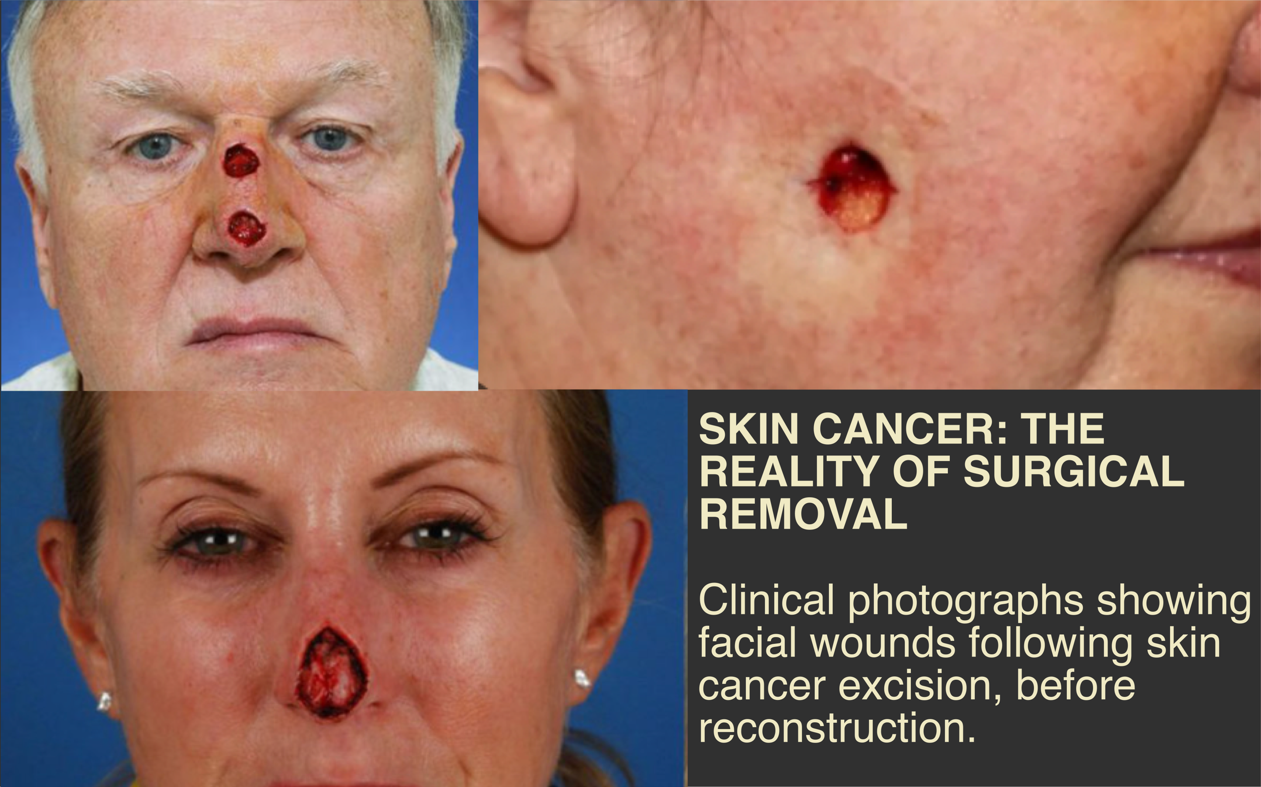 Clinical photographs showing facial surgical wounds following skin cancer removal, before reconstruction