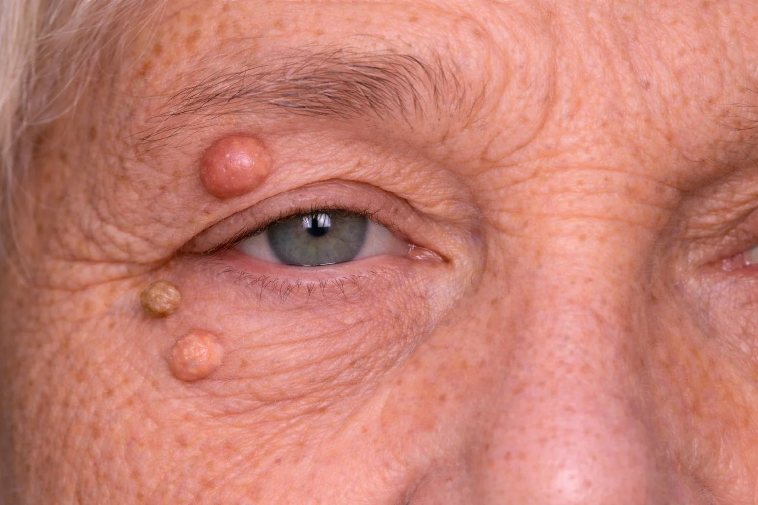 Close-up of an older man's face showing gray eye, wrinkled skin, and three skin growths around the eye.
