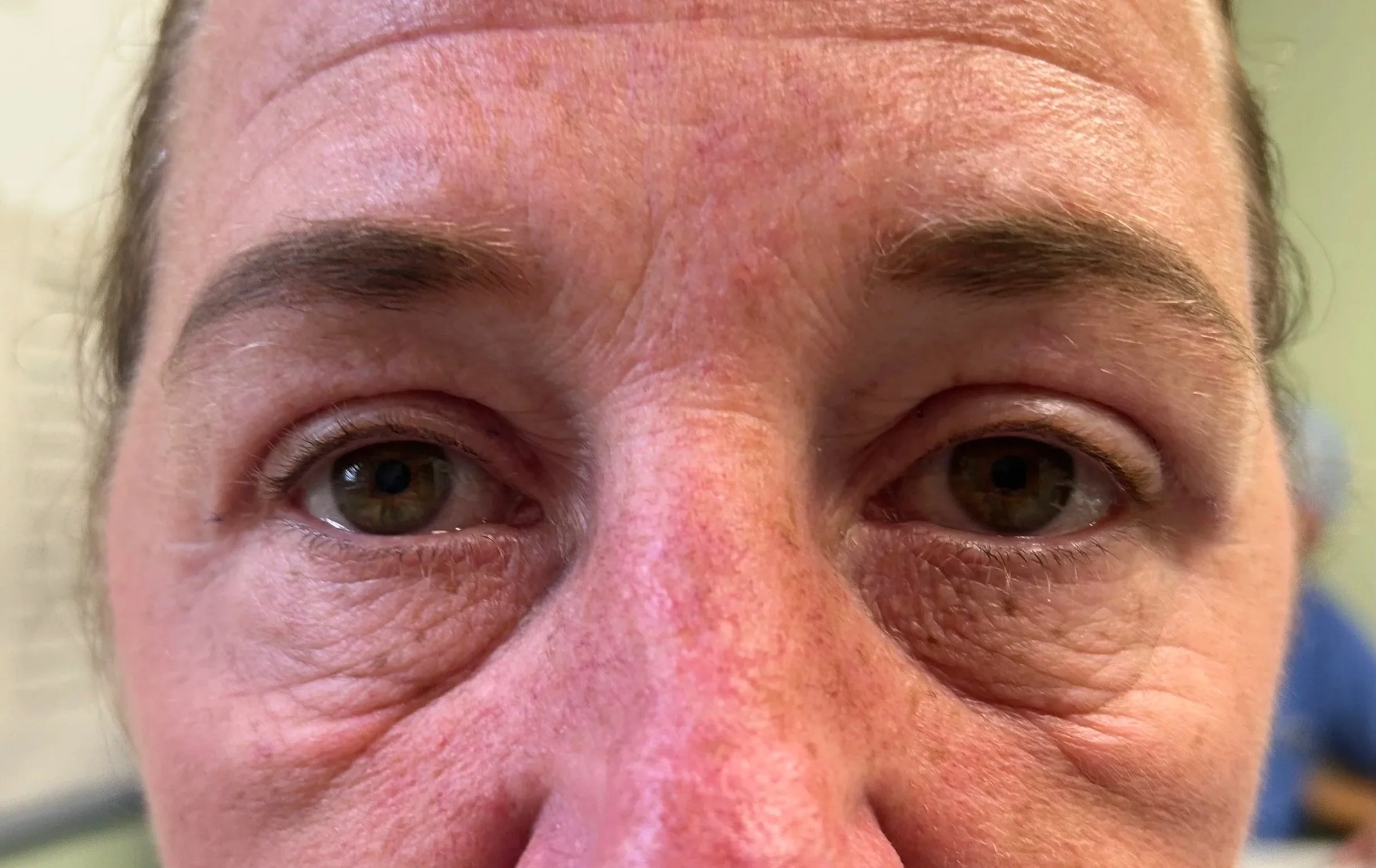 Before and after upper eyelid blepharoplasty performed by Consultant Ophthalmologist Chris Matthews in Newcastle upon Tyne.