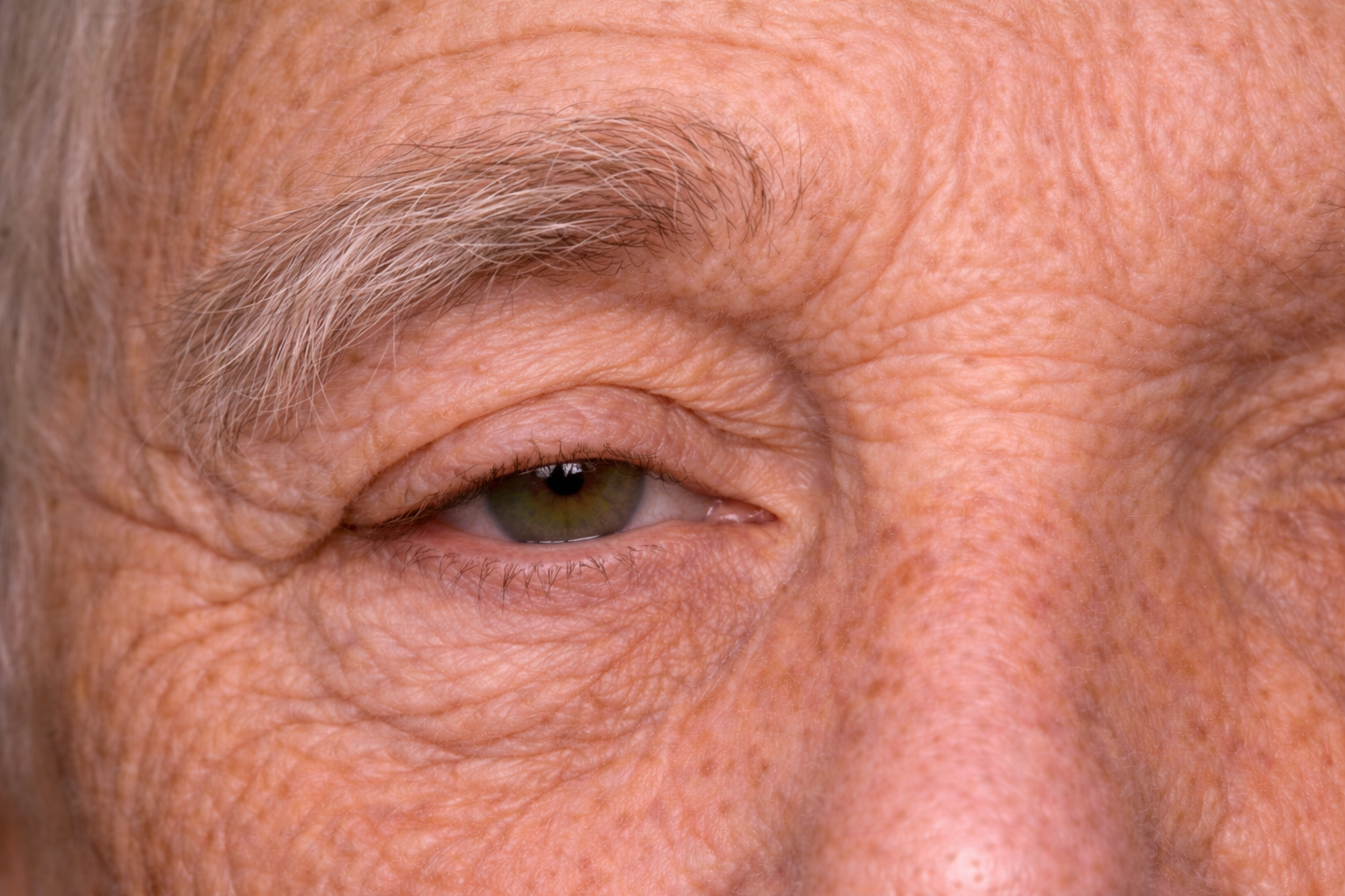 Close-up of an elderly man's face, focusing on the drooping eyebrow also know as brow ptosis