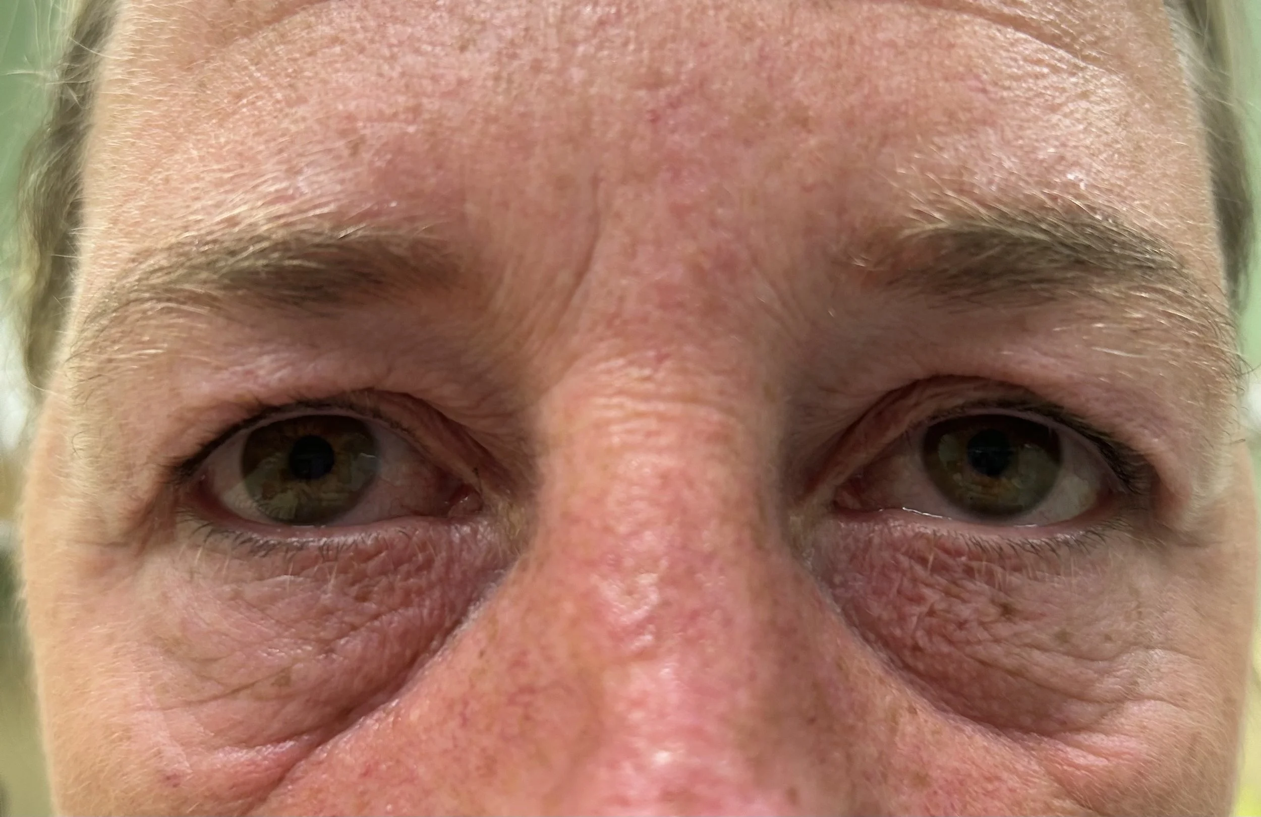 Before and after upper eyelid blepharoplasty performed by Consultant Ophthalmologist Chris Matthews in Newcastle upon Tyne.