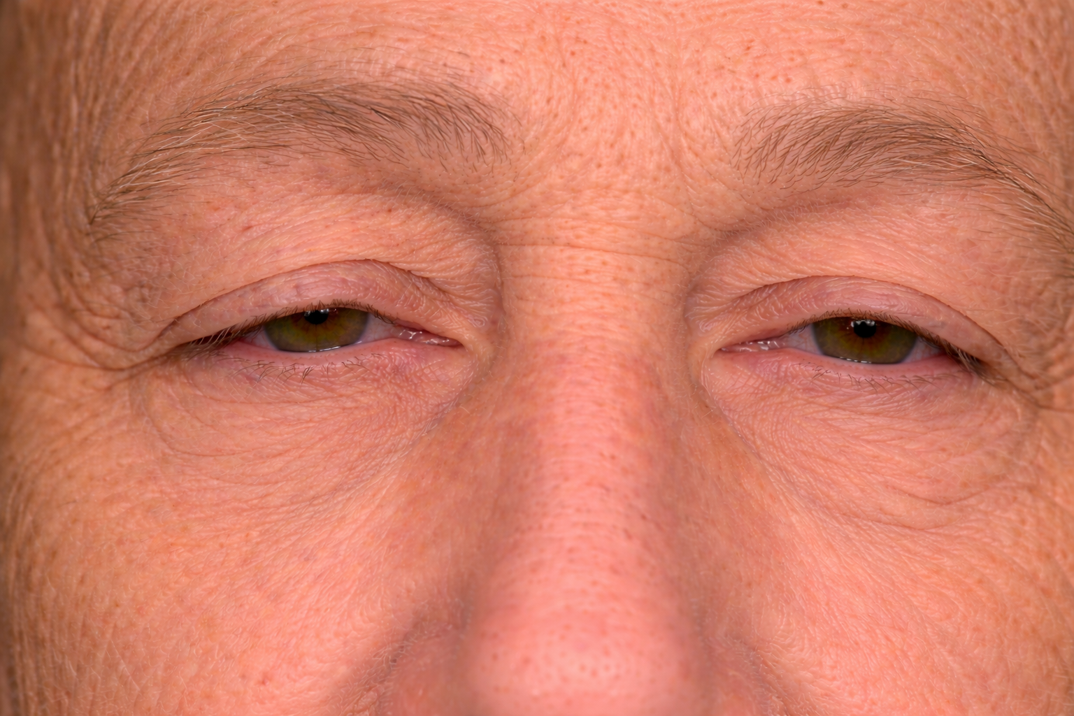 Close-up of an older person's face showing upper lid ptosis which are droopy eyelids