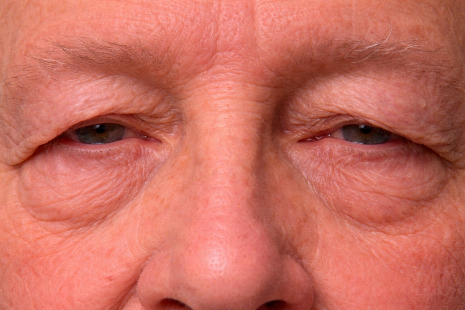 Close-up of an elderly person's face showing the eyes which have excess skin tot he upper lids known as dermatochalasis