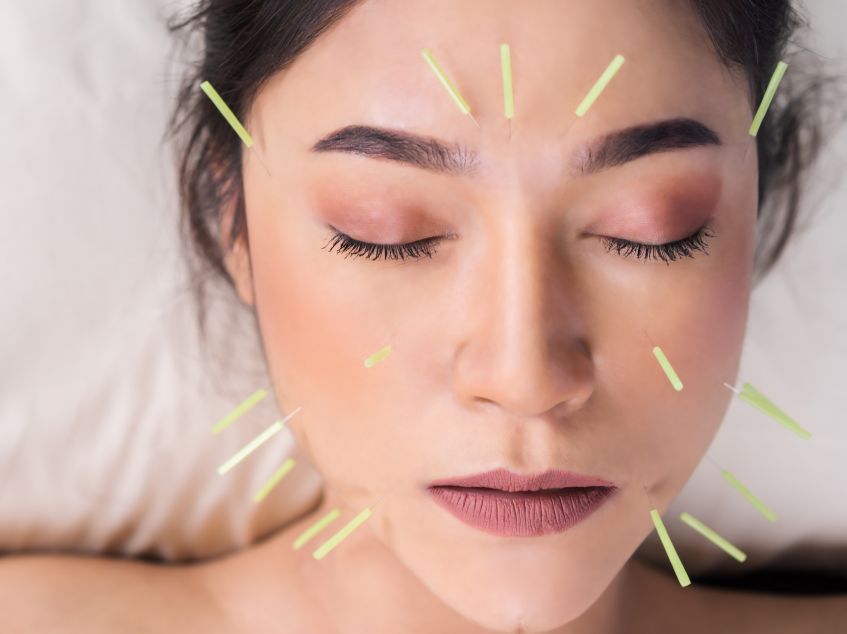 Facial Rejuvenation Acupuncture