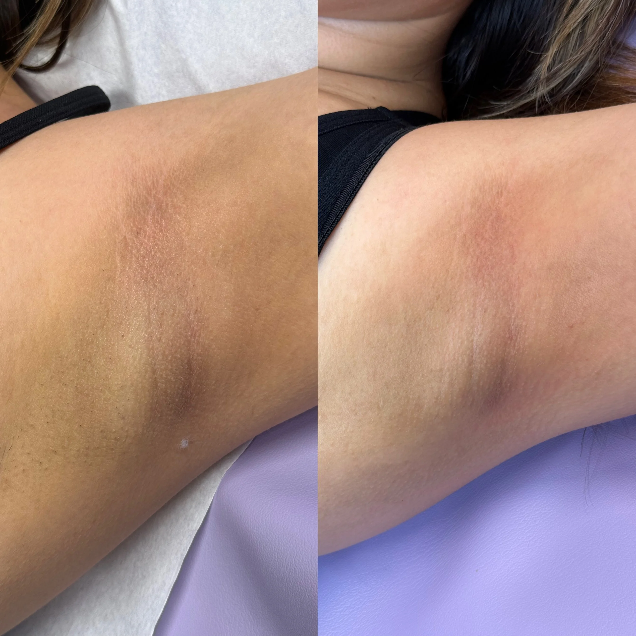 underarm and intimate brightening/lightening in arlington tx