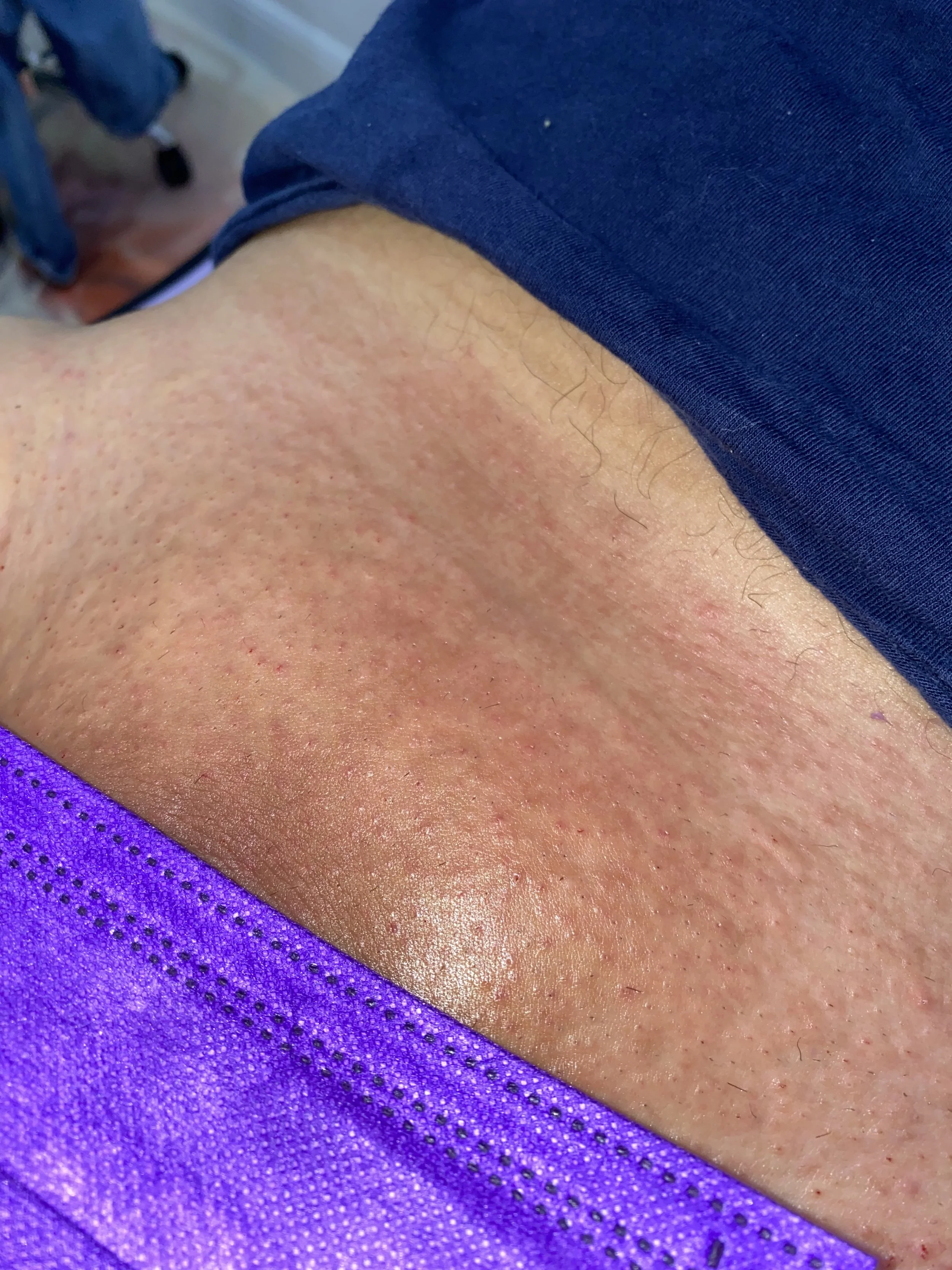 Brazilian wax (P) anatomy