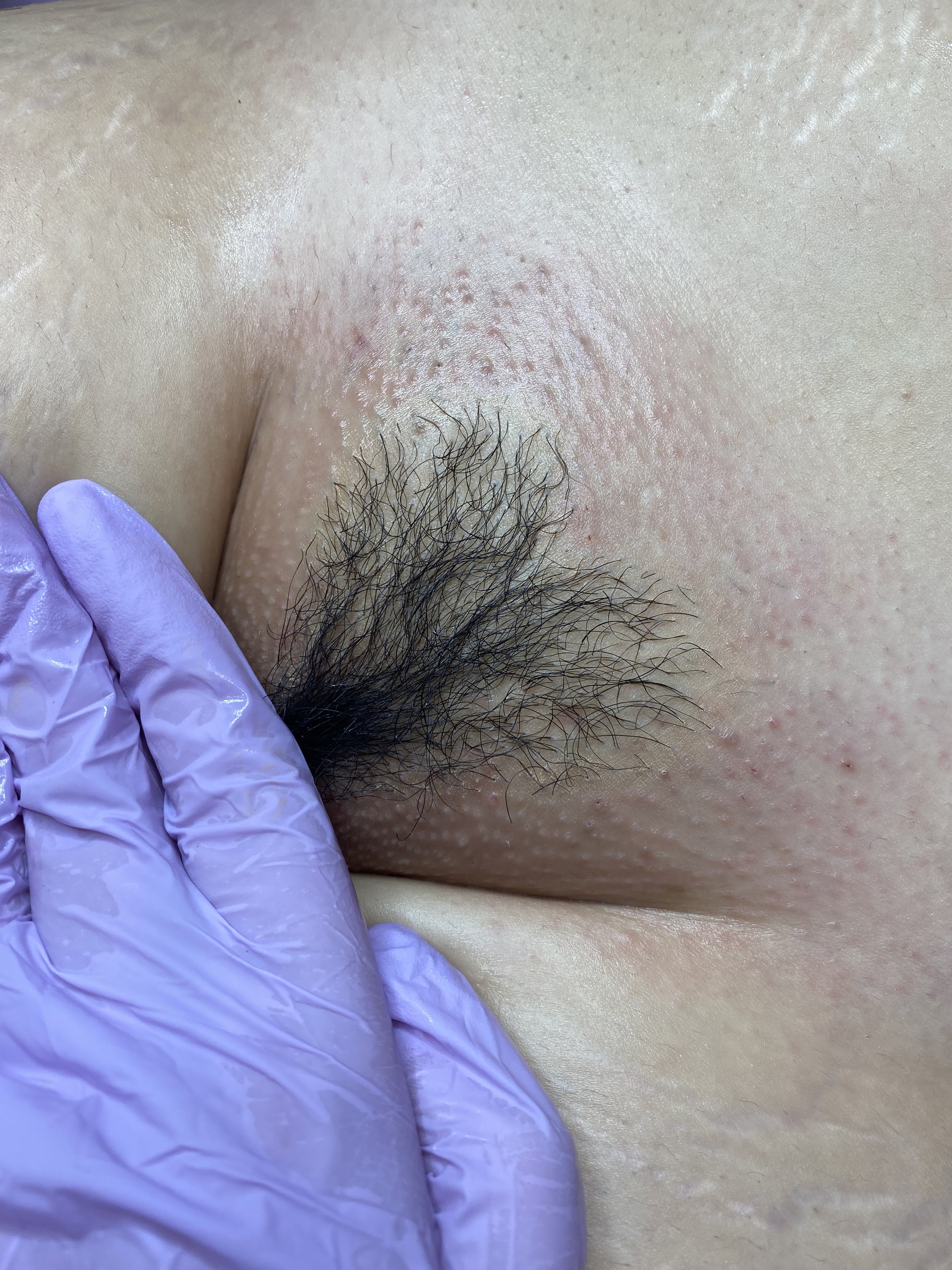 Brazilian wax (v) anatomy