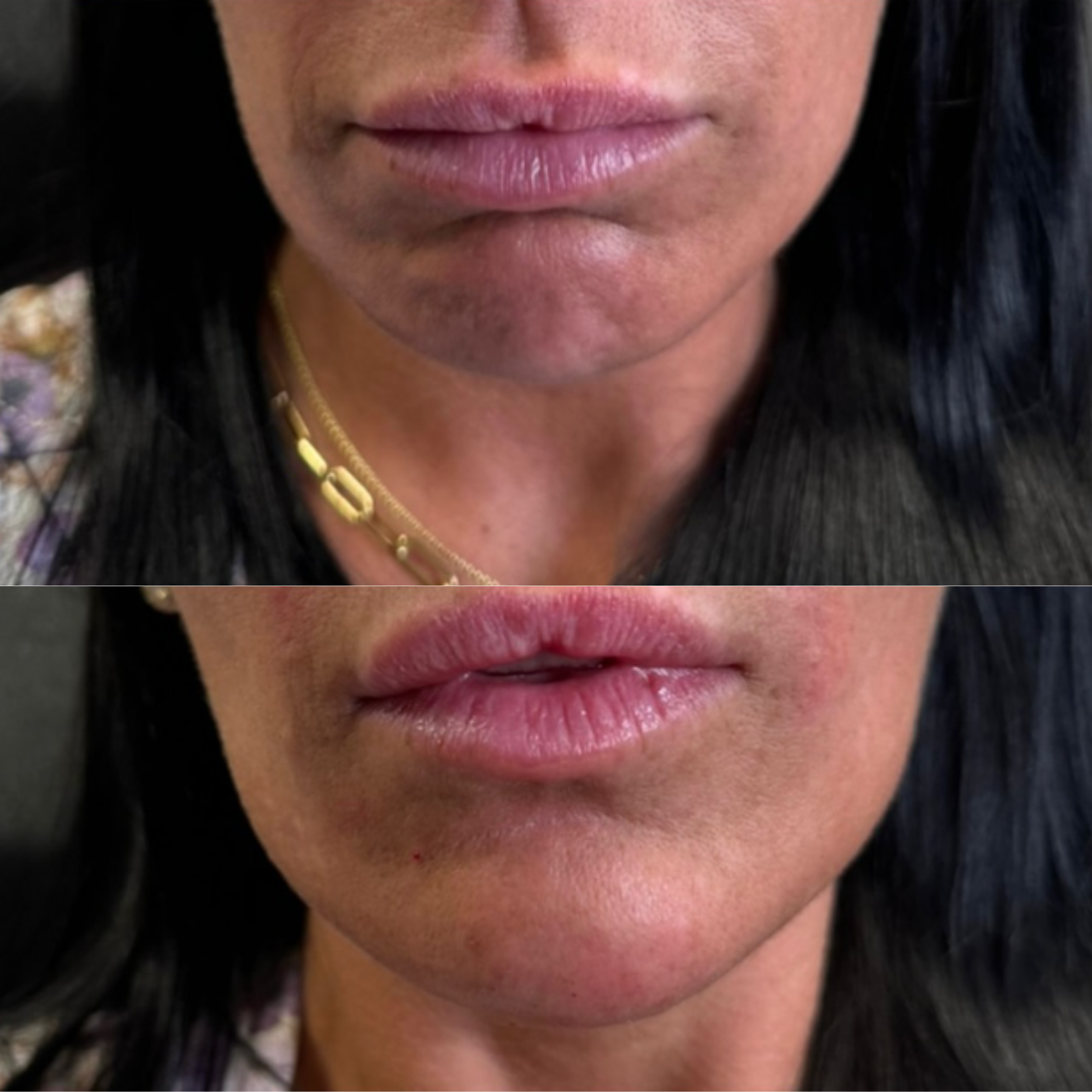 Close-up of a woman's lips, showing before and after images of a cosmetic lip procedure.