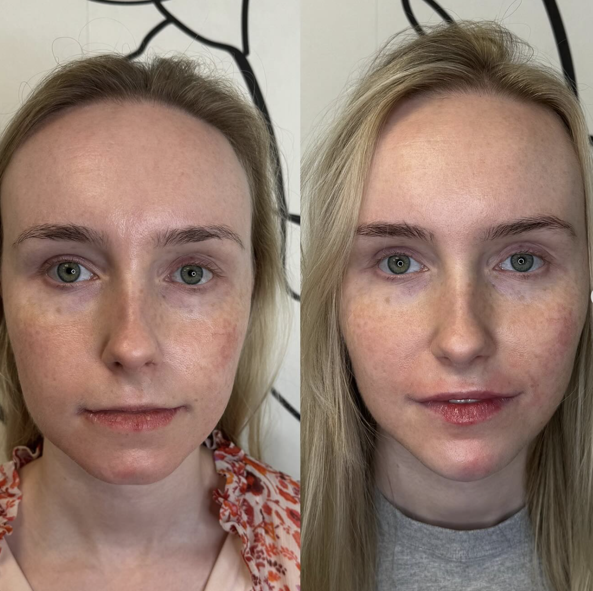 Side-by-side comparison of a woman before and after multiple syringes of facial filler, giving her a more balanced and healthy appearance.