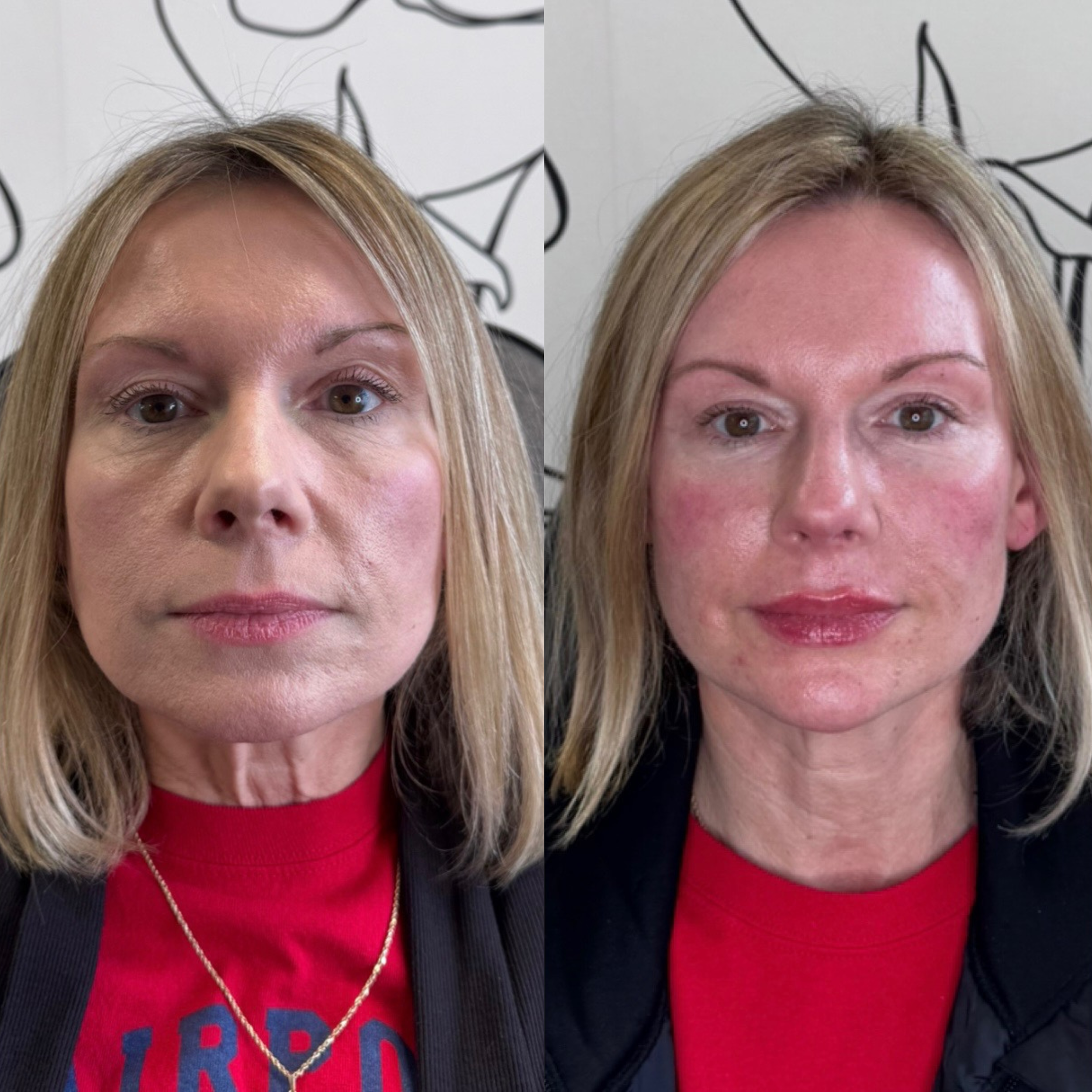 Side-by-side comparison of a woman before and after dermal fillers, with visible improvements in skin plumpness and balance, making her appear younger.