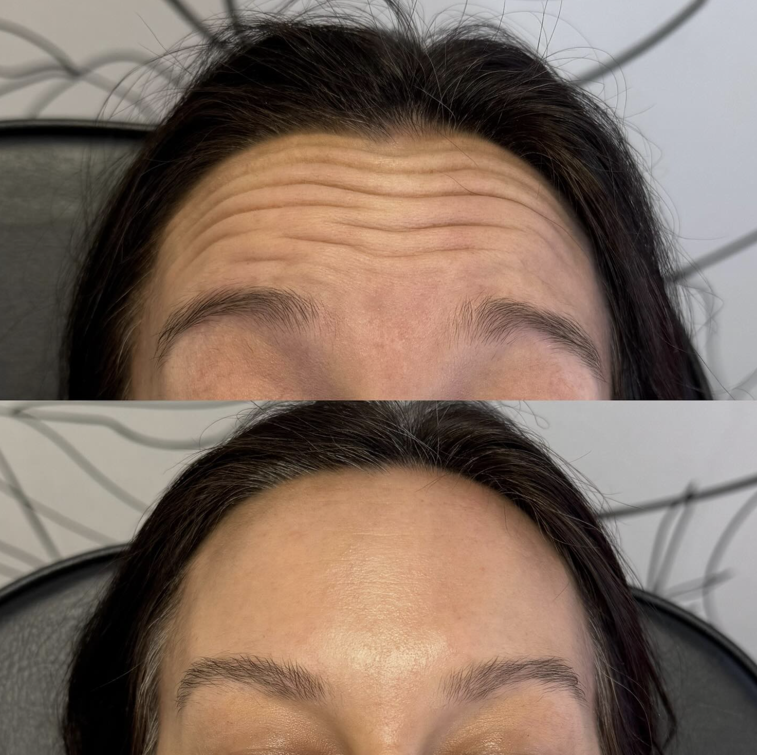 Close-up of a woman's forehead showing before and after treatments; the top shows wrinkles and lines, the bottom shows smoother skin.