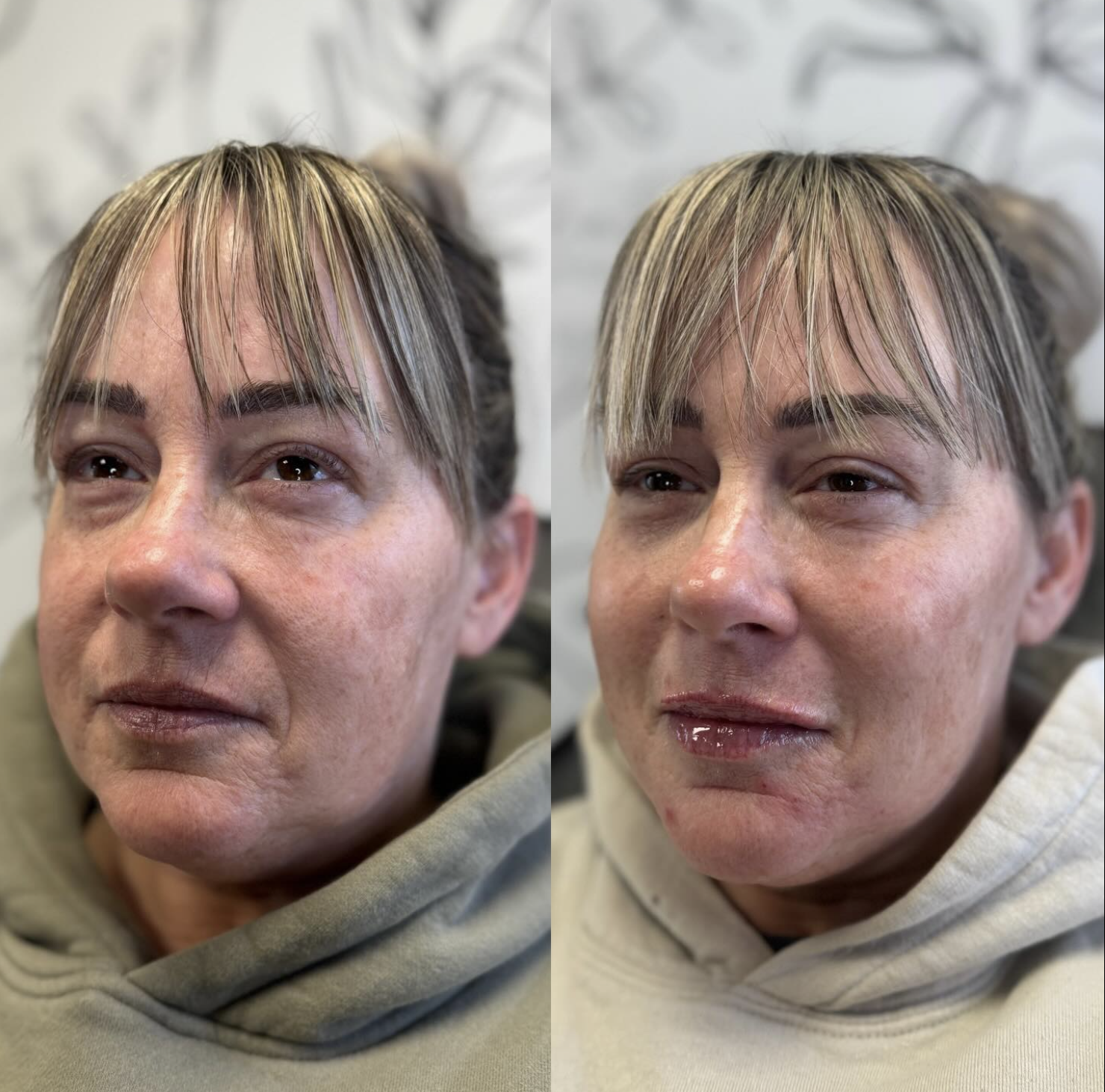 A side-by-side comparison of a woman with bangs after getting filler in her face.