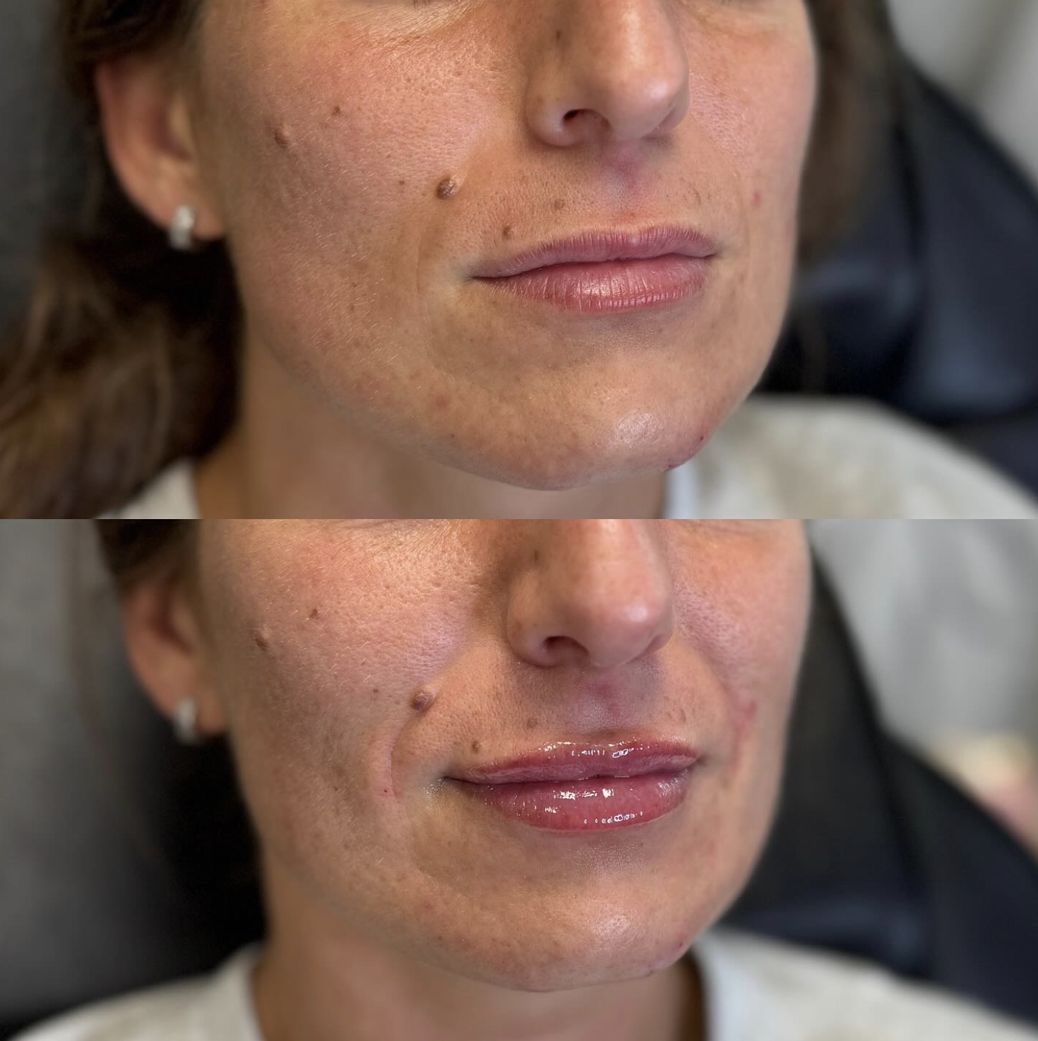 Close-up of a woman's face showing before and after a cosmetic treatment; the top image shows her face with visible skin imperfections and dry lips, while the bottom image shows her with smoother skin and glossy lips.