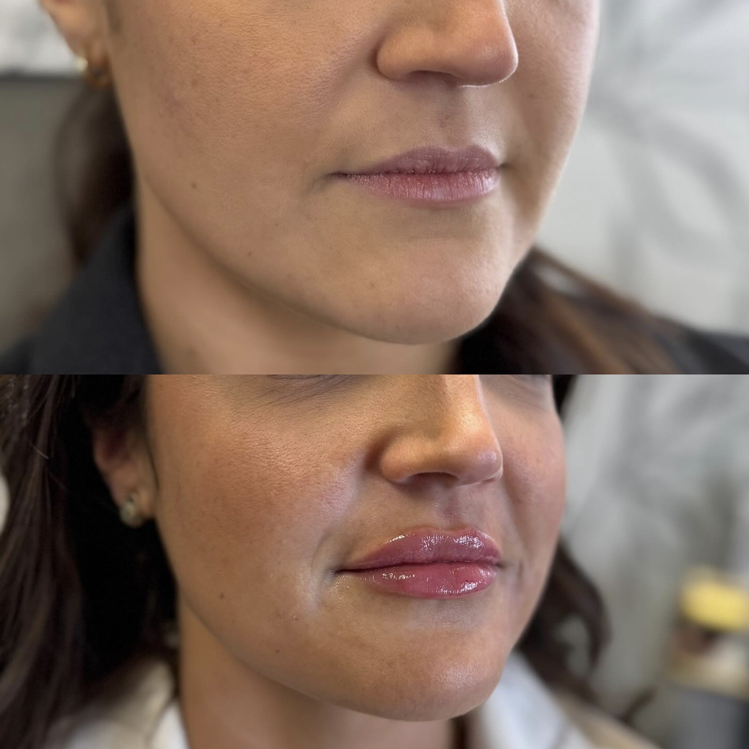 Before and after of a lip filler client, showing improved lip fullness and smoothness after treatment.
