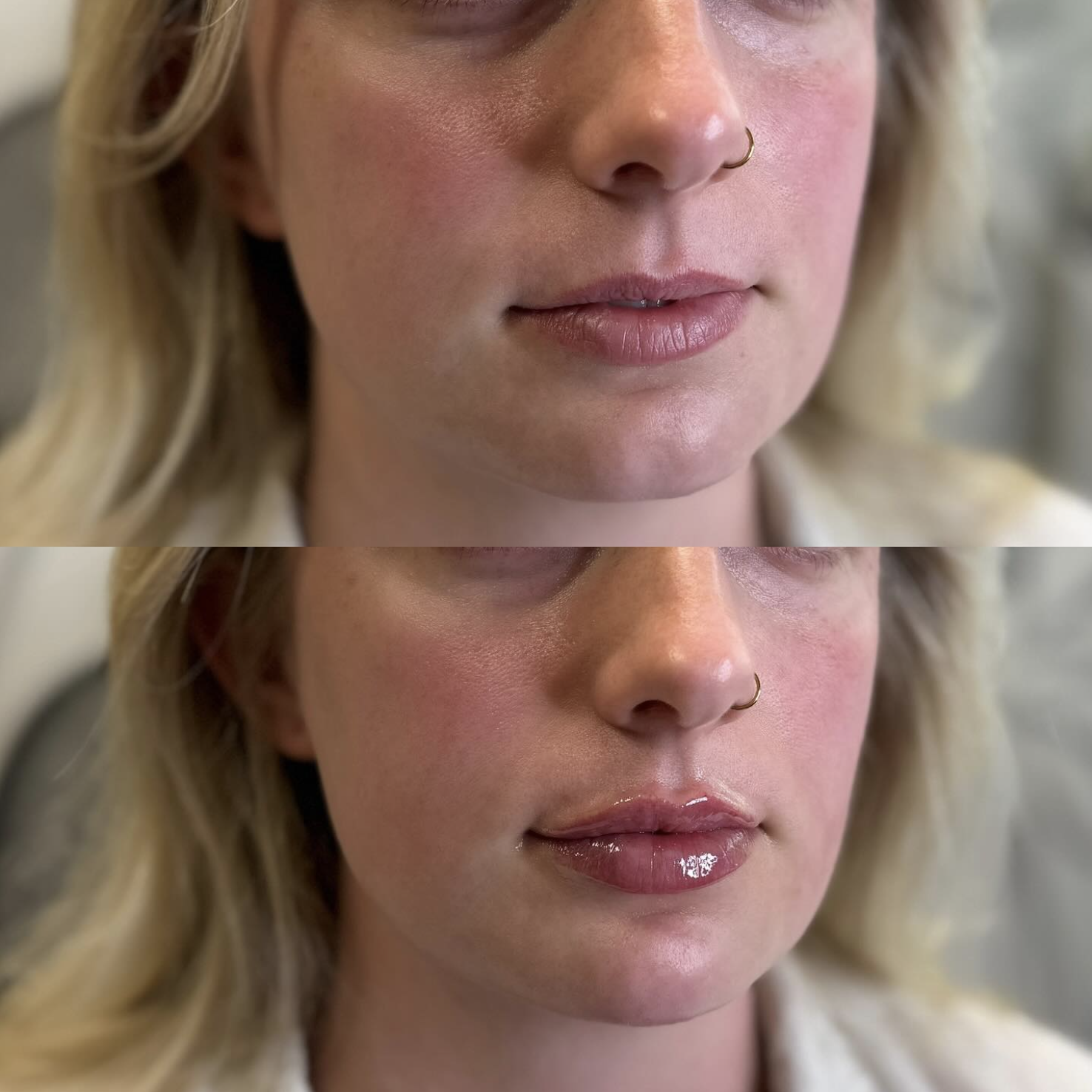 Before and after of a lip filler client, showing improved lip fullness and smoothness after treatment.