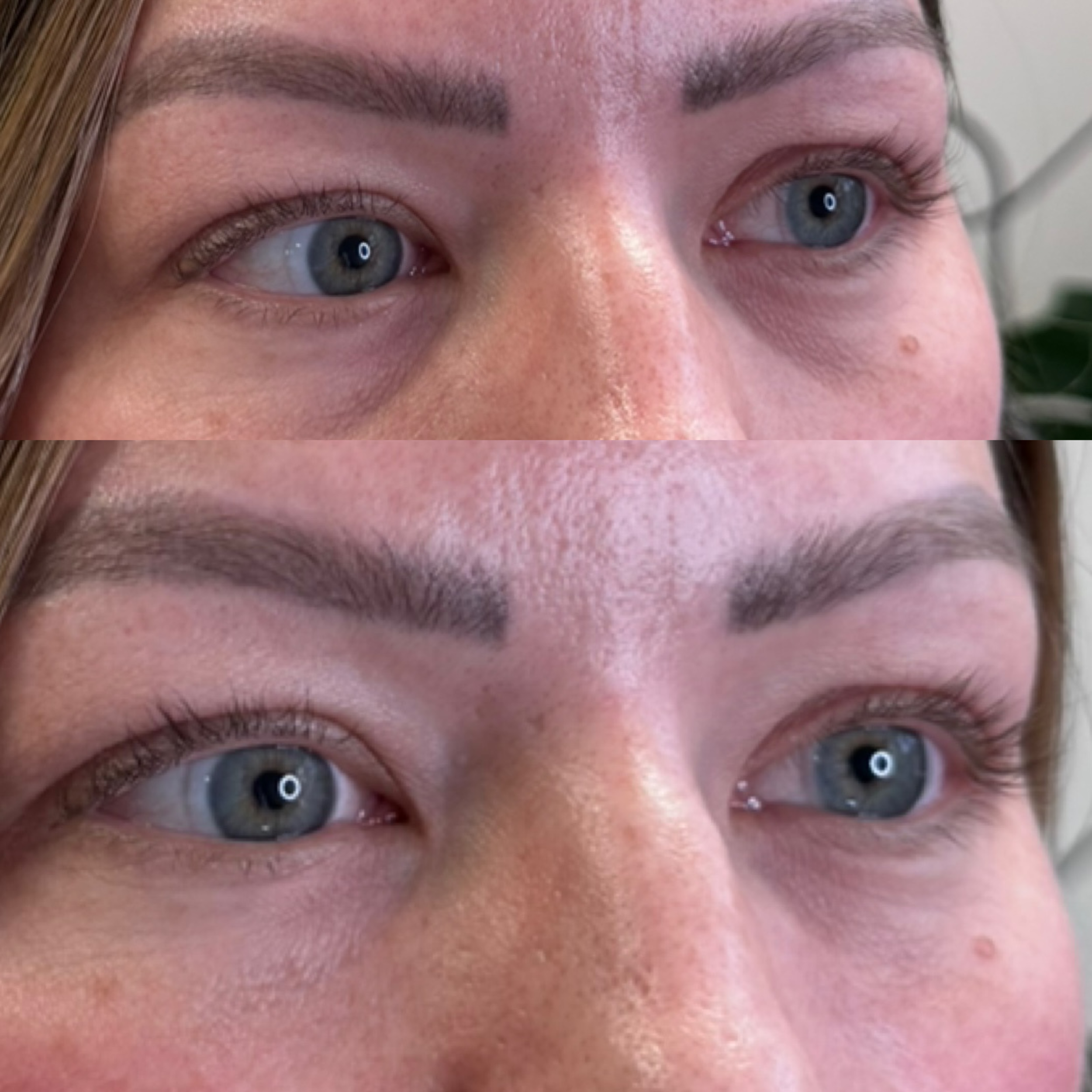 Close-up of a woman's face before and after under eye filler.