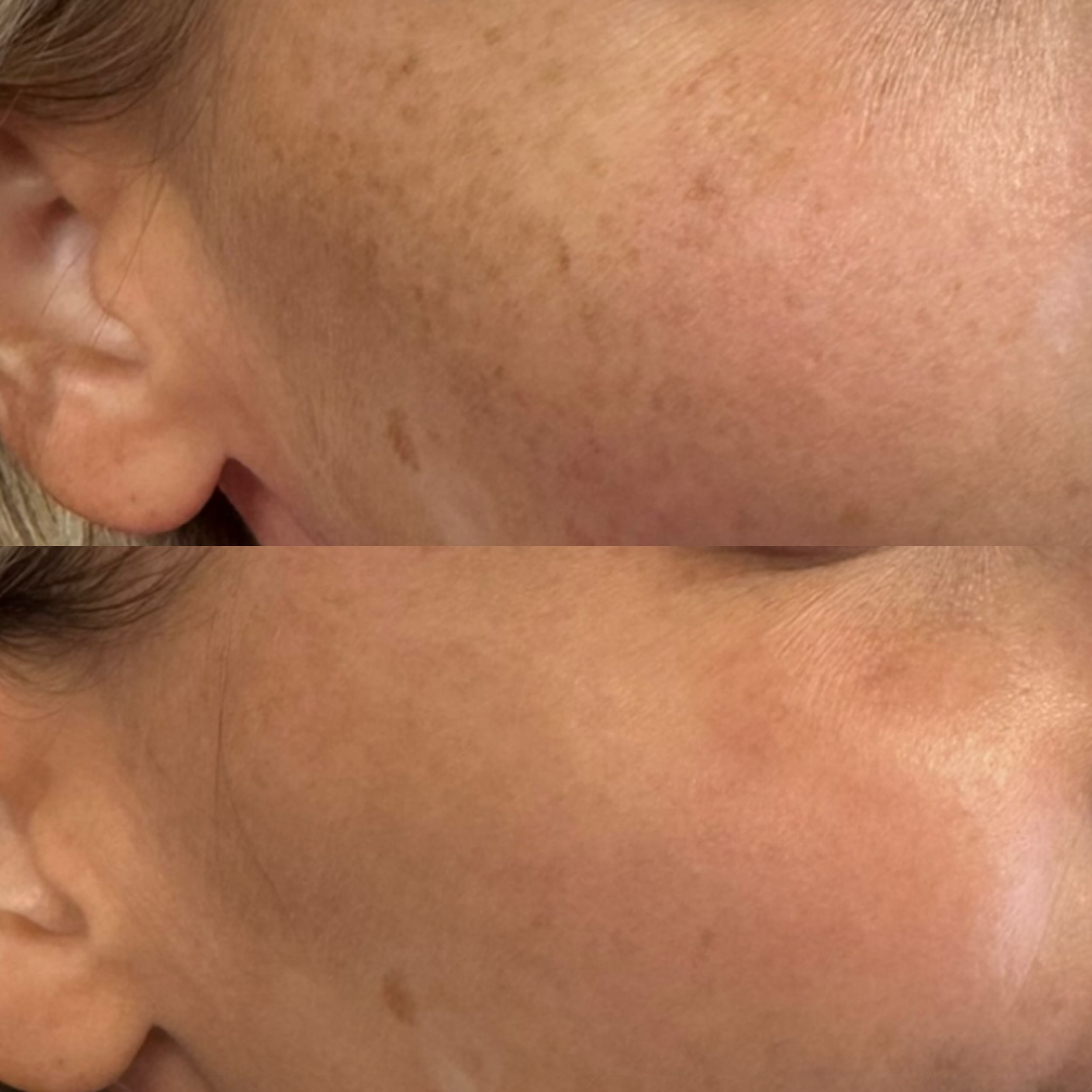 A comparison of a person's facial skin before and after laser treatment, showing significant reduction in pigmentation and freckles on the cheeks.