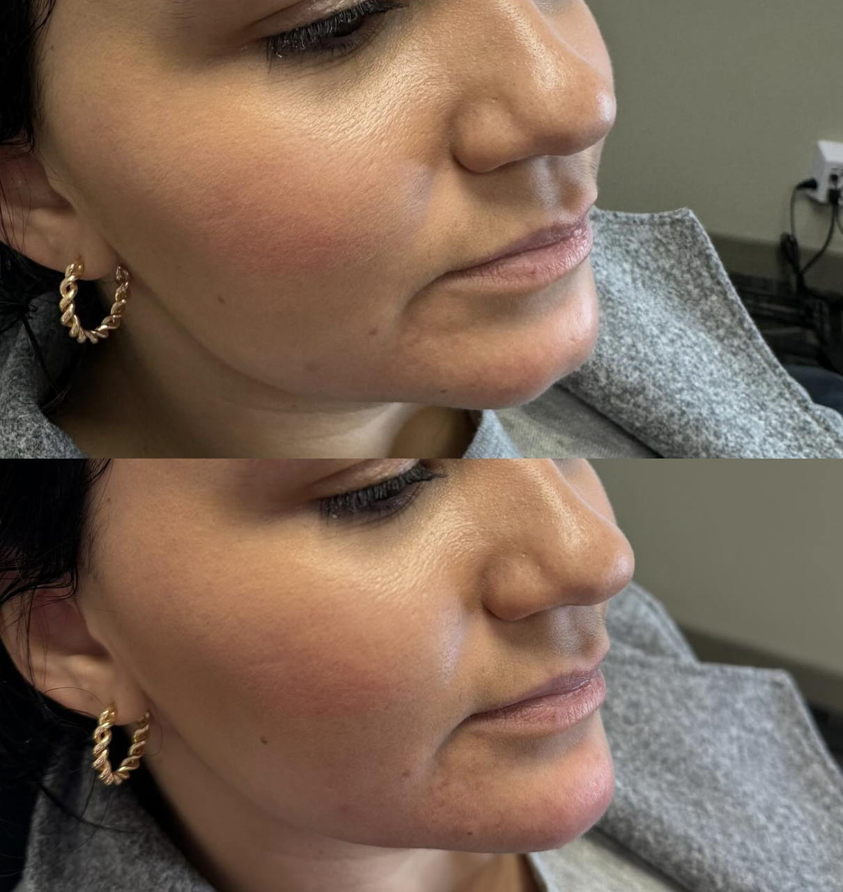 Comparison of woman's face before and chin filler.