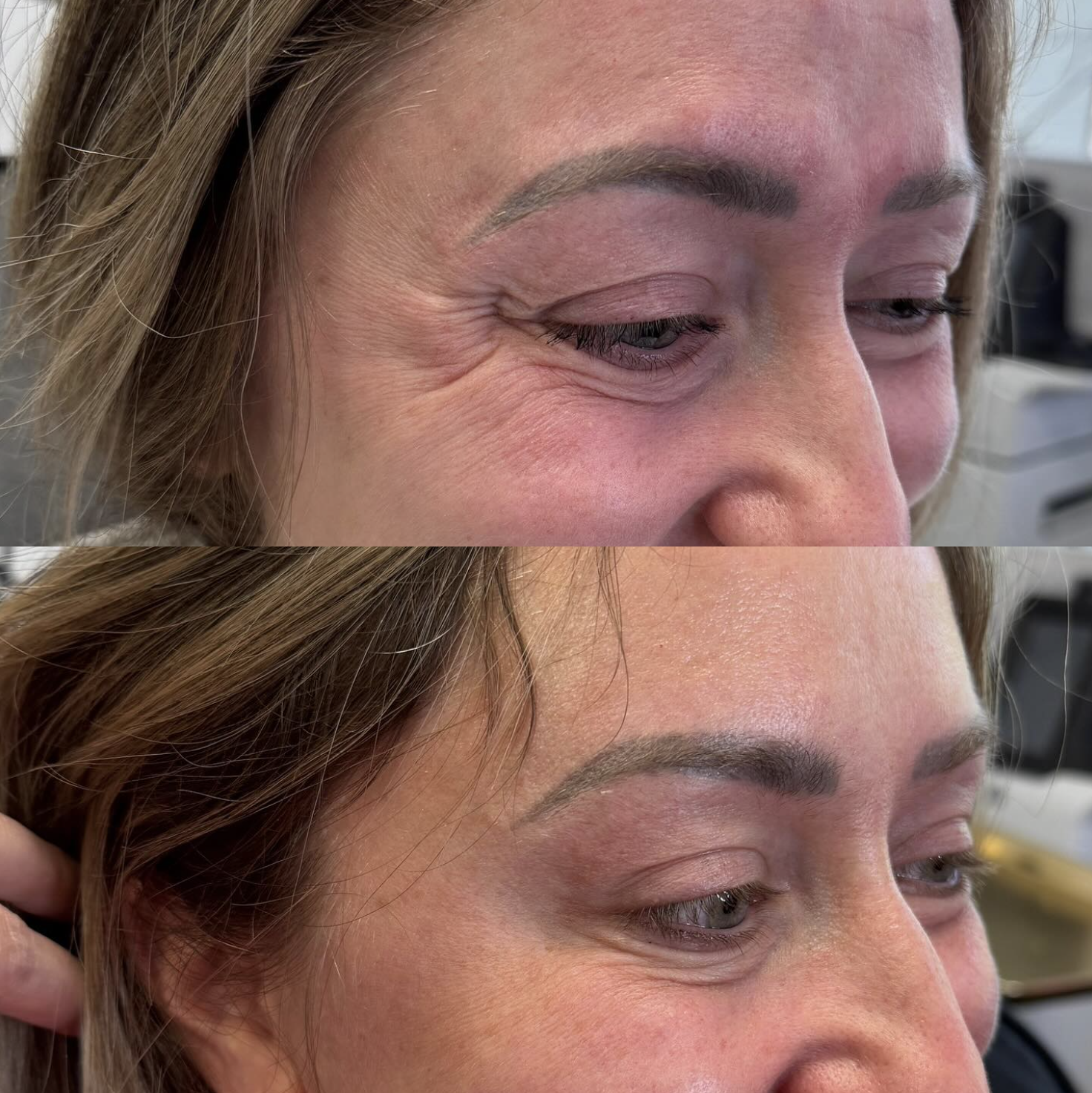 Close-up of a woman's face showing before and after for Botox around the eyes, highlighting reduced wrinkles and smoother skin.