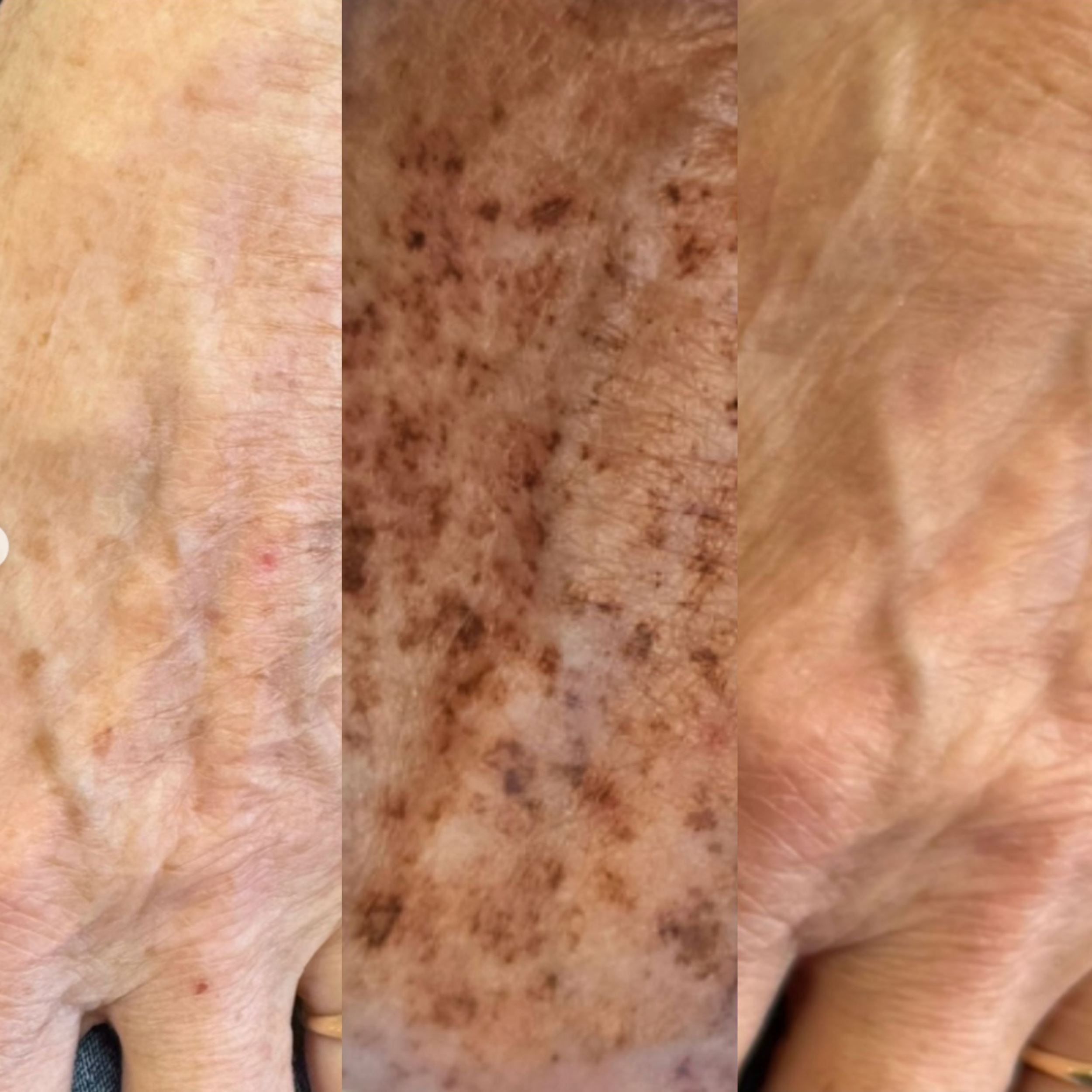 Close-up of skin showing signs of age and pigmentation, including wrinkles, age spots, and uneven pigmentation.