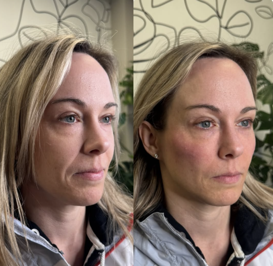 Side-by-side comparison of a woman before and after filler appointment, showing a healthier appearance.